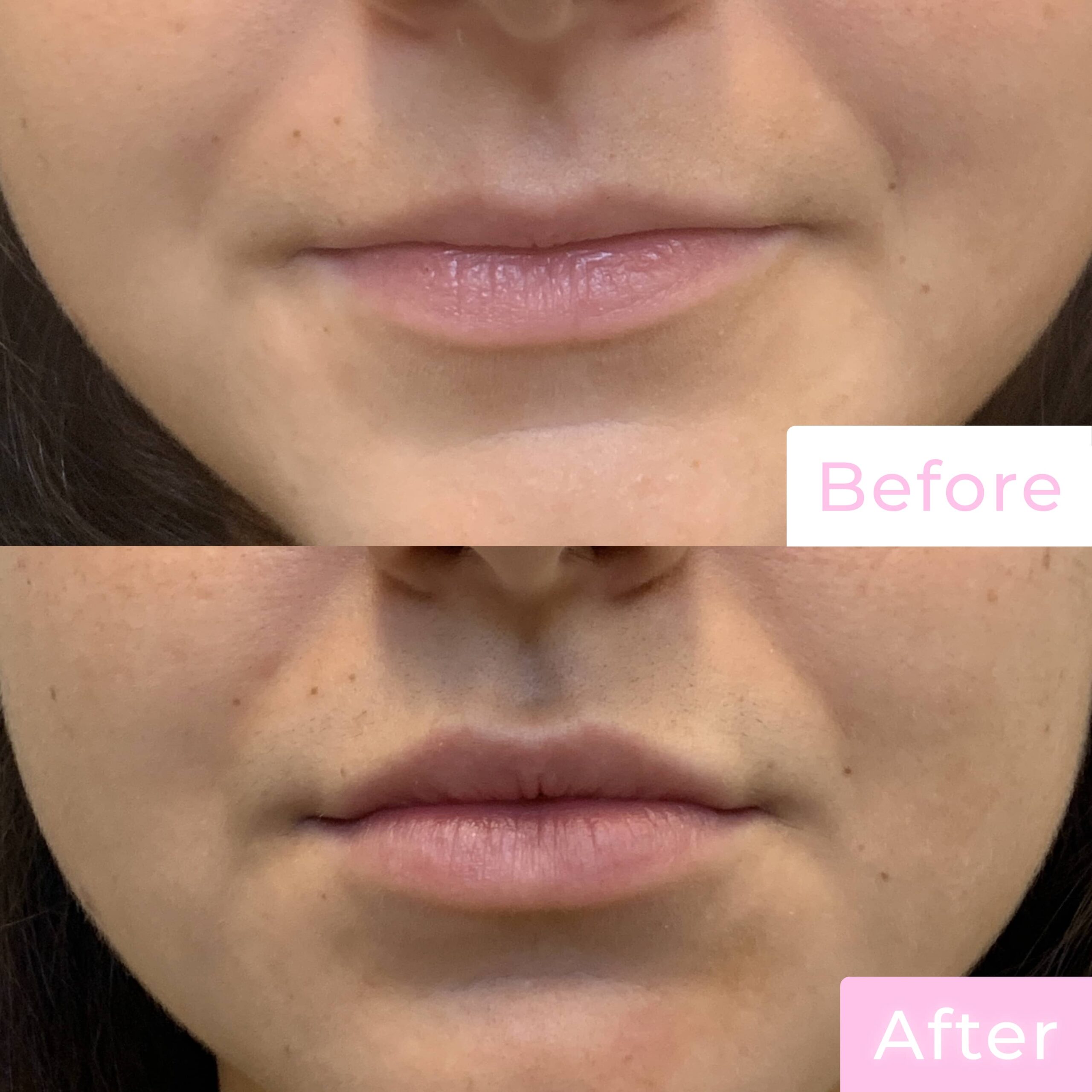 Fillers Before & After Gallery - Patient 12506 - Image 1