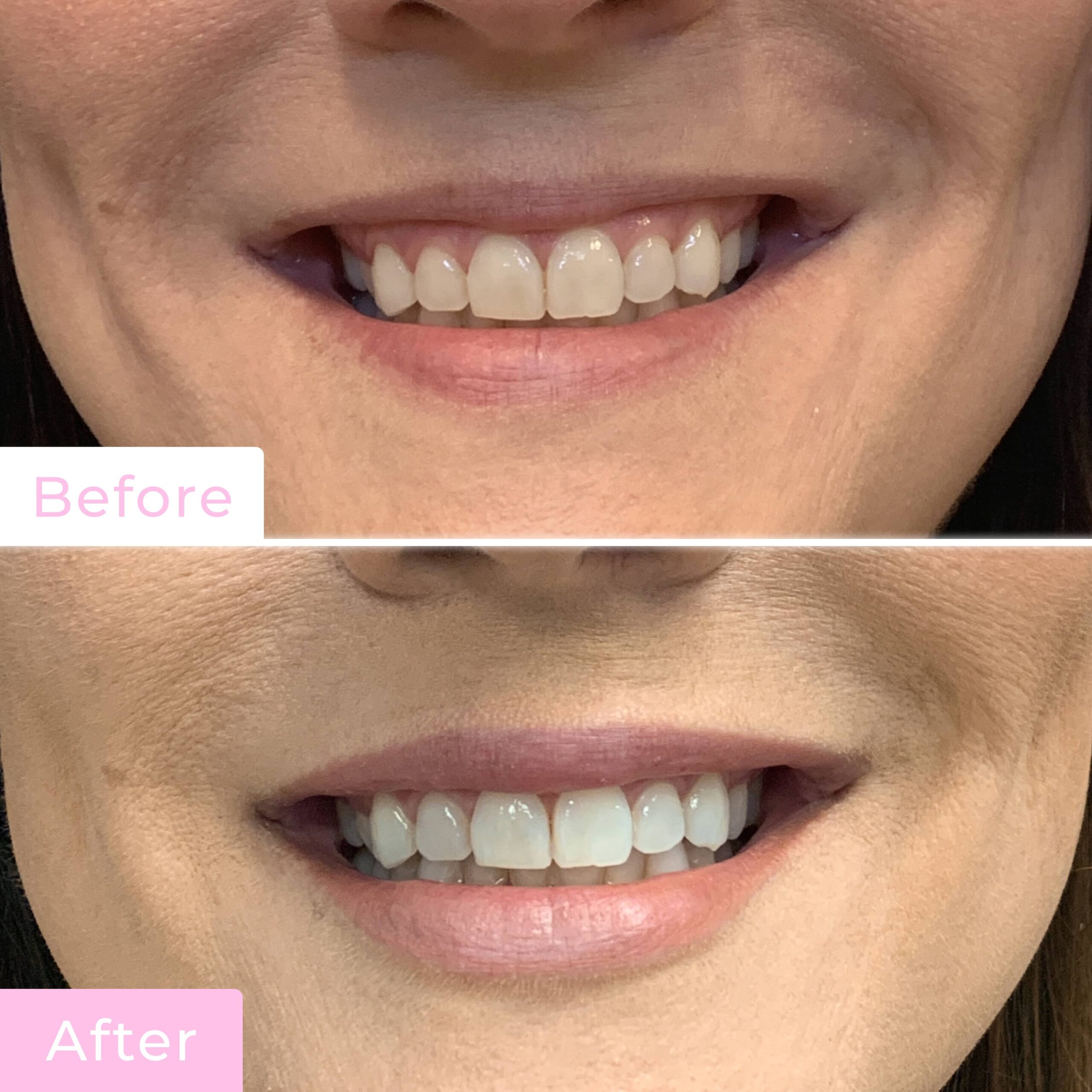Fillers Before & After Gallery - Patient 12489 - Image 2