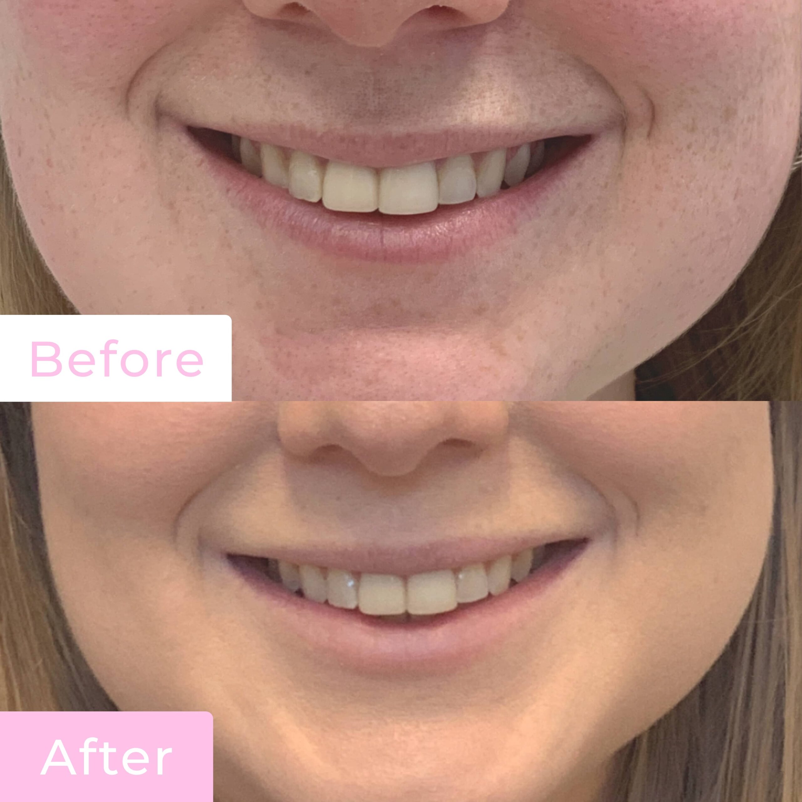 Fillers Before & After Gallery - Patient 12496 - Image 2