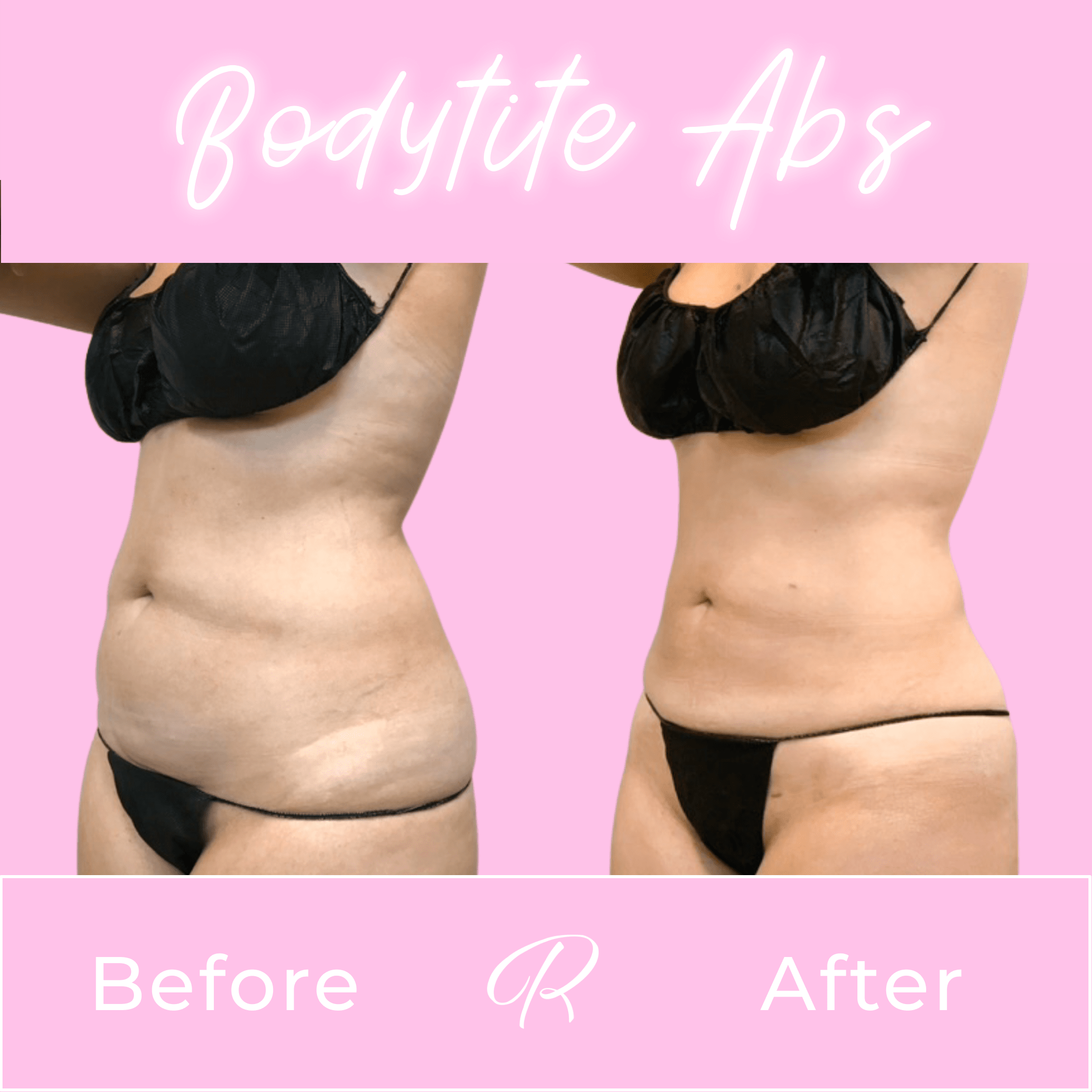 BodyTite Before & After Gallery - Patient 13203 - Image 2