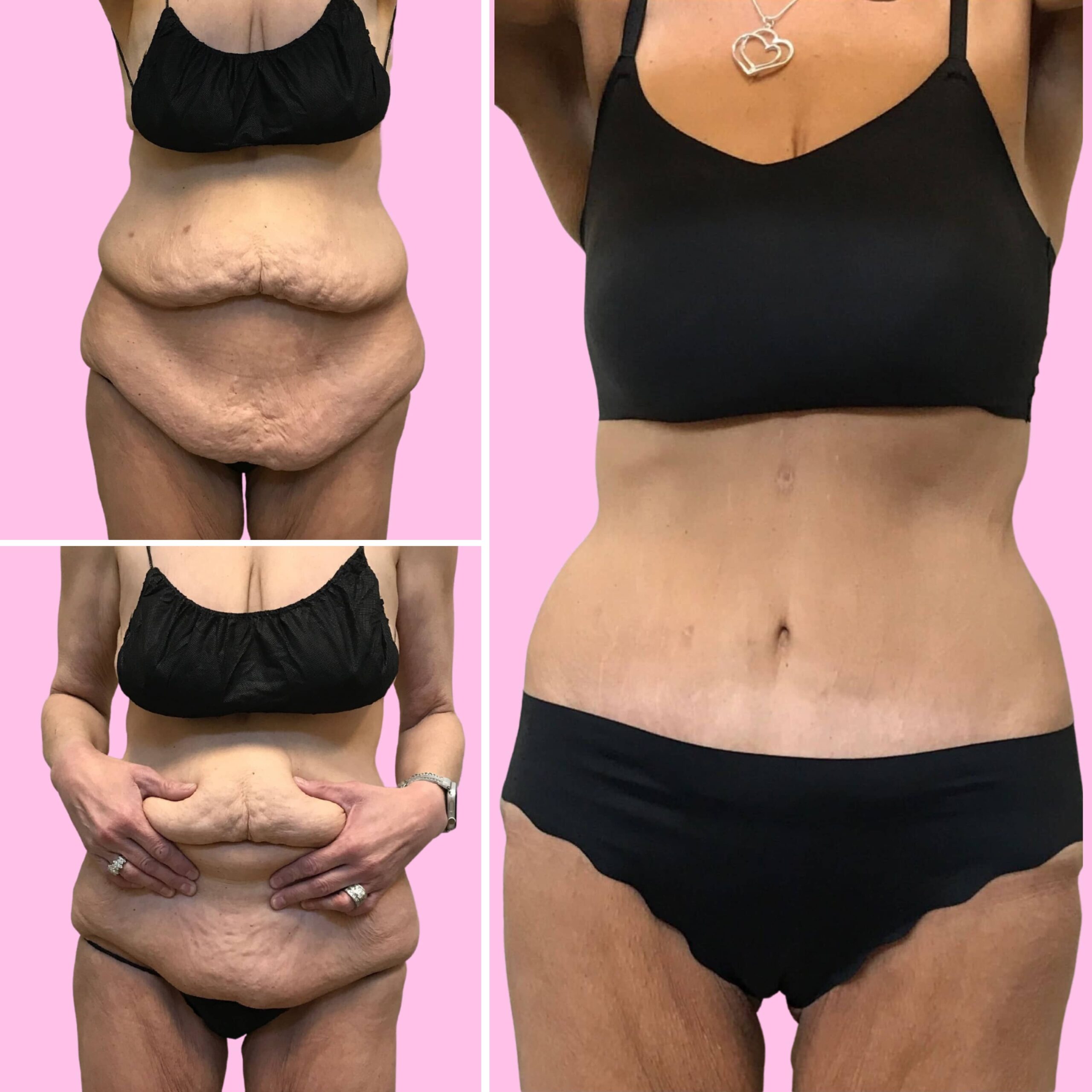 Tummy Tuck Before & After Gallery - Patient 13240 - Image 1