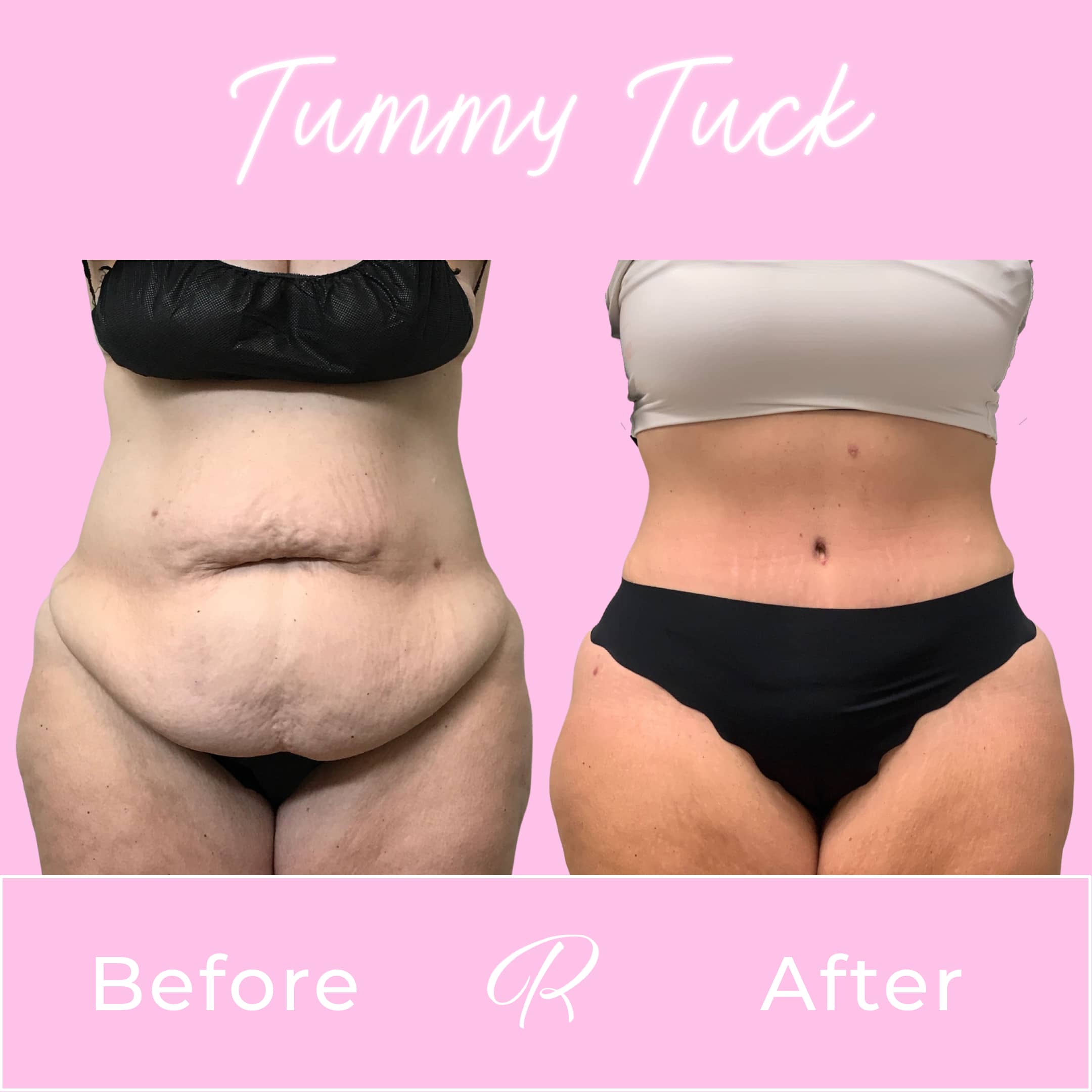 Tummy Tuck Before & After Gallery - Patient 13231 - Image 1