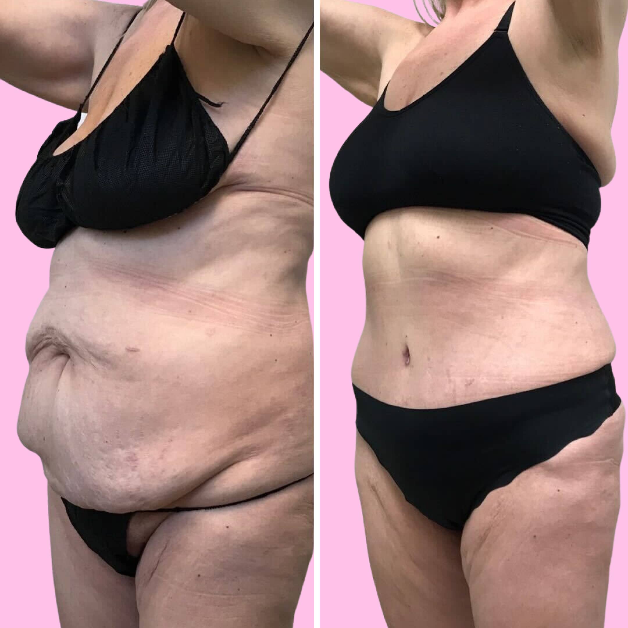 Tummy Tuck Before & After Gallery - Patient 13227 - Image 2