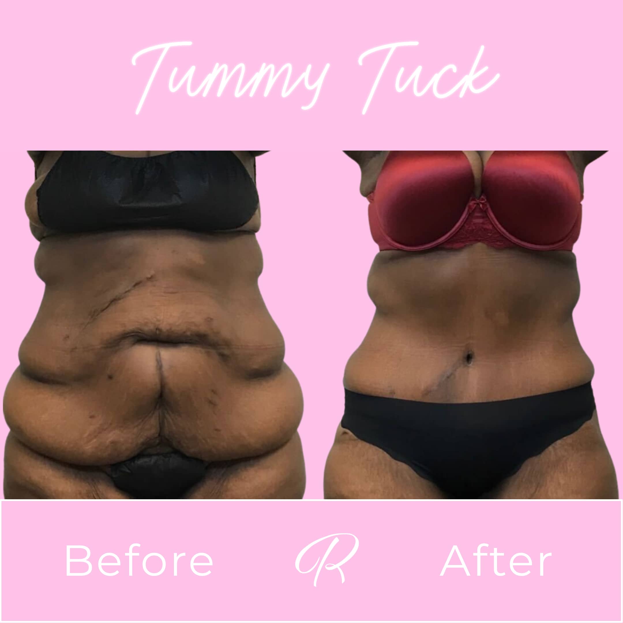 Tummy Tuck Before & After Gallery - Patient 13219 - Image 1