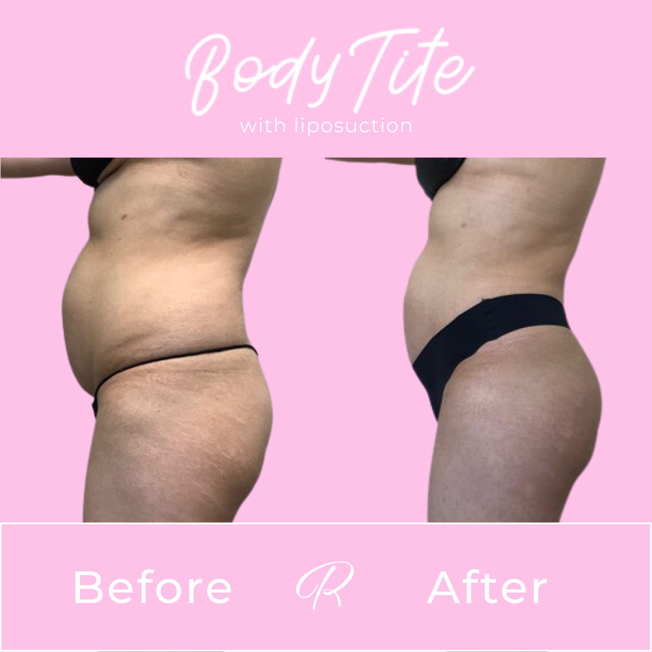 BodyTite Before & After Gallery - Patient 13435 - Image 2
