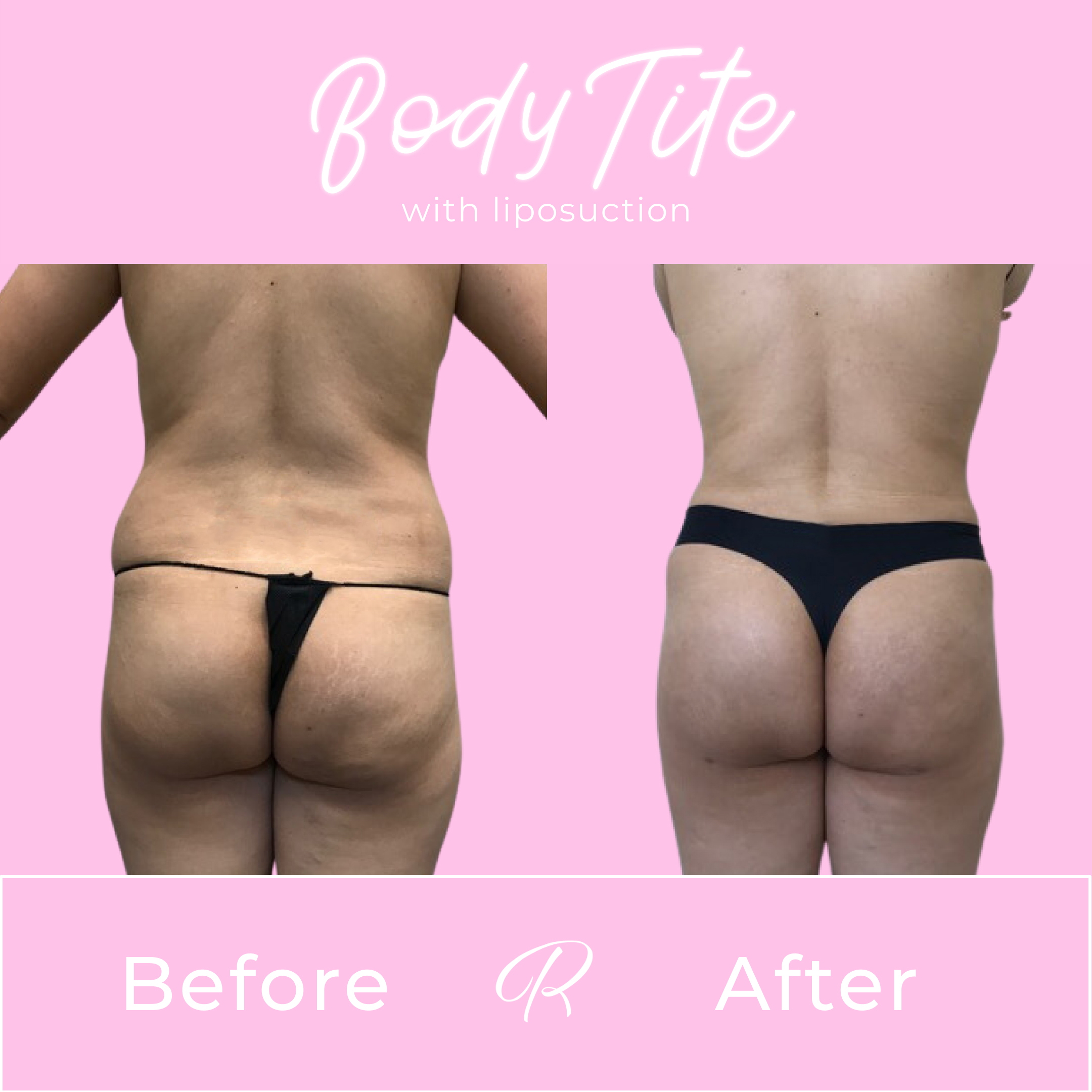 BodyTite Before & After Gallery - Patient 13435 - Image 3