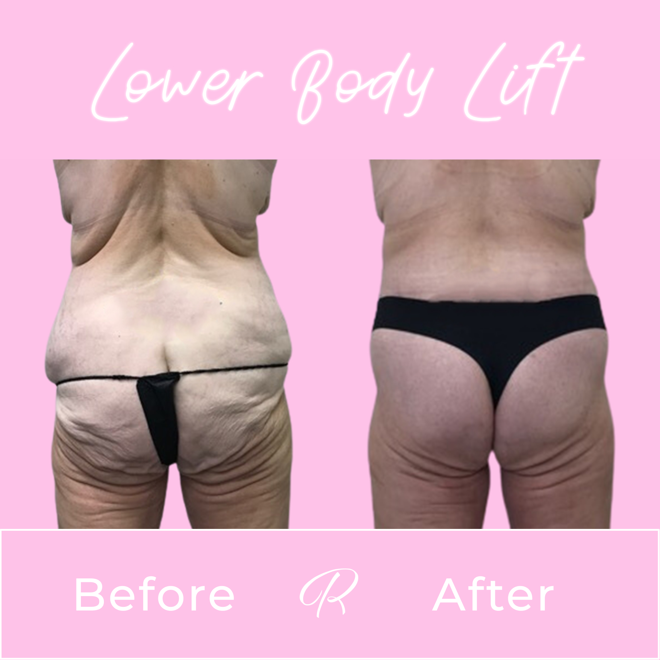 Lower Body Lift Before & After Gallery - Patient 13382 - Image 3