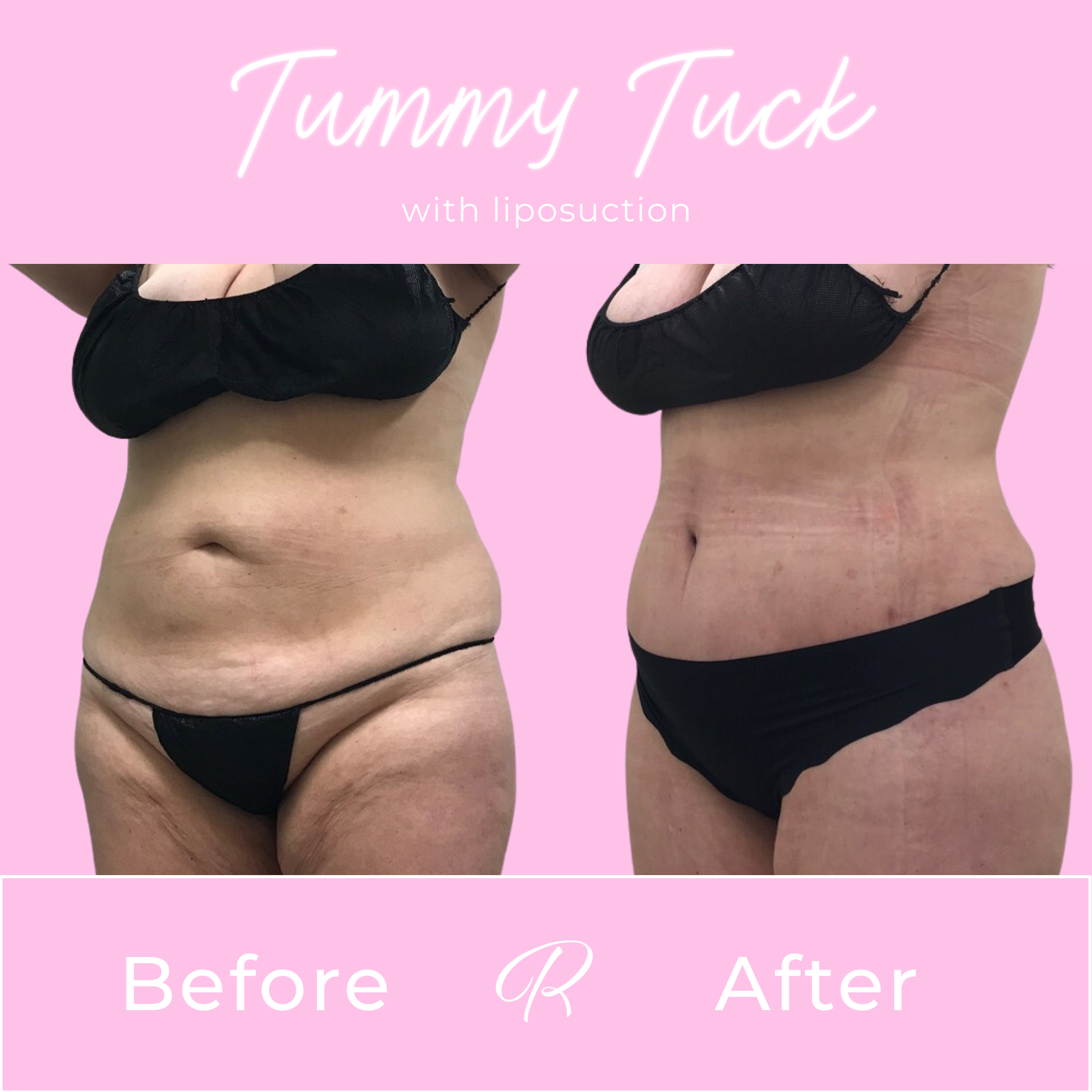 Tummy Tuck Before & After Gallery - Patient 13260 - Image 2