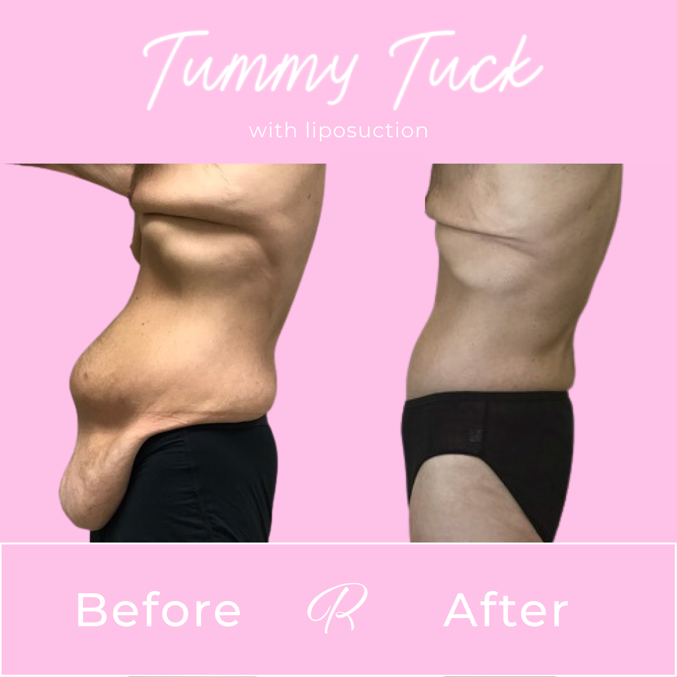 Tummy Tuck Before & After Gallery - Patient 13258 - Image 2