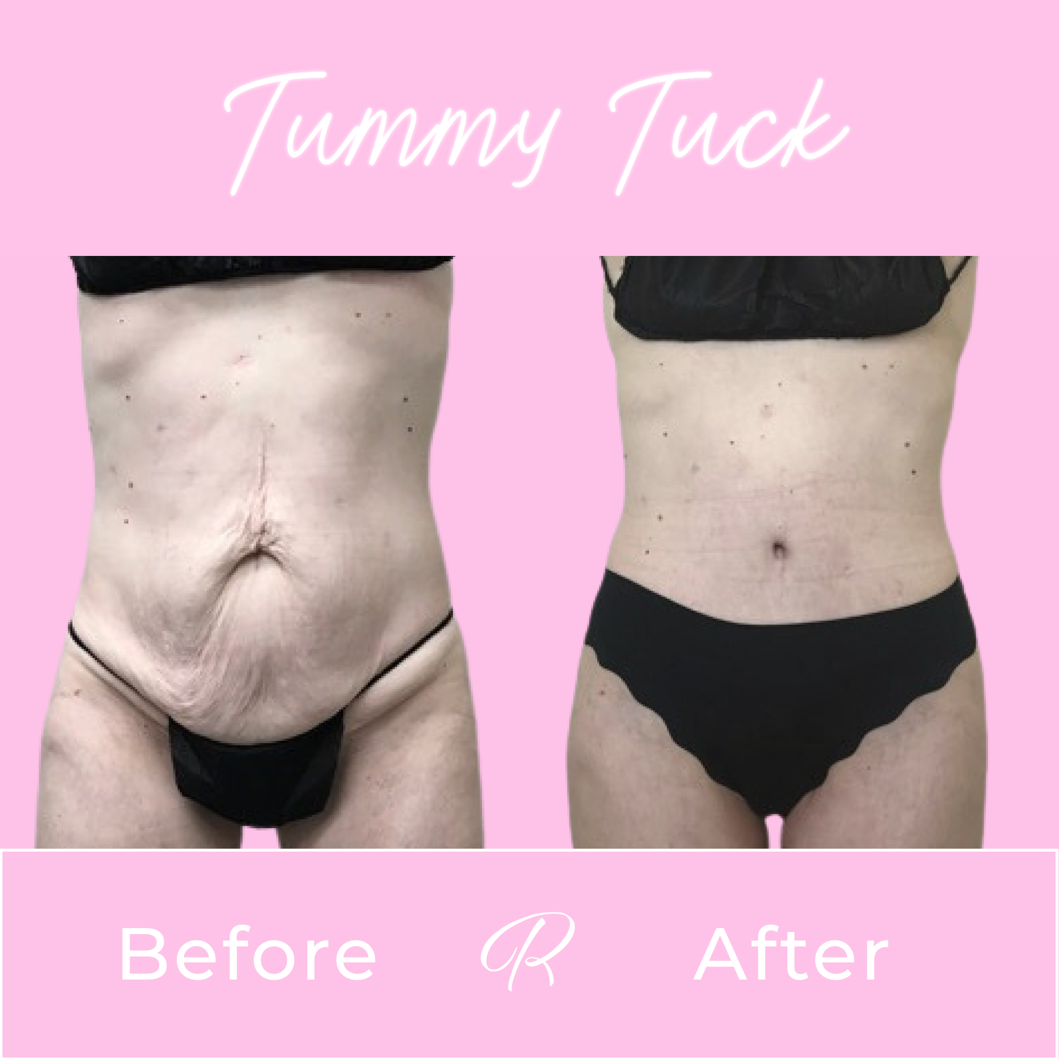 Tummy Tuck Before & After Gallery - Patient 13259 - Image 1