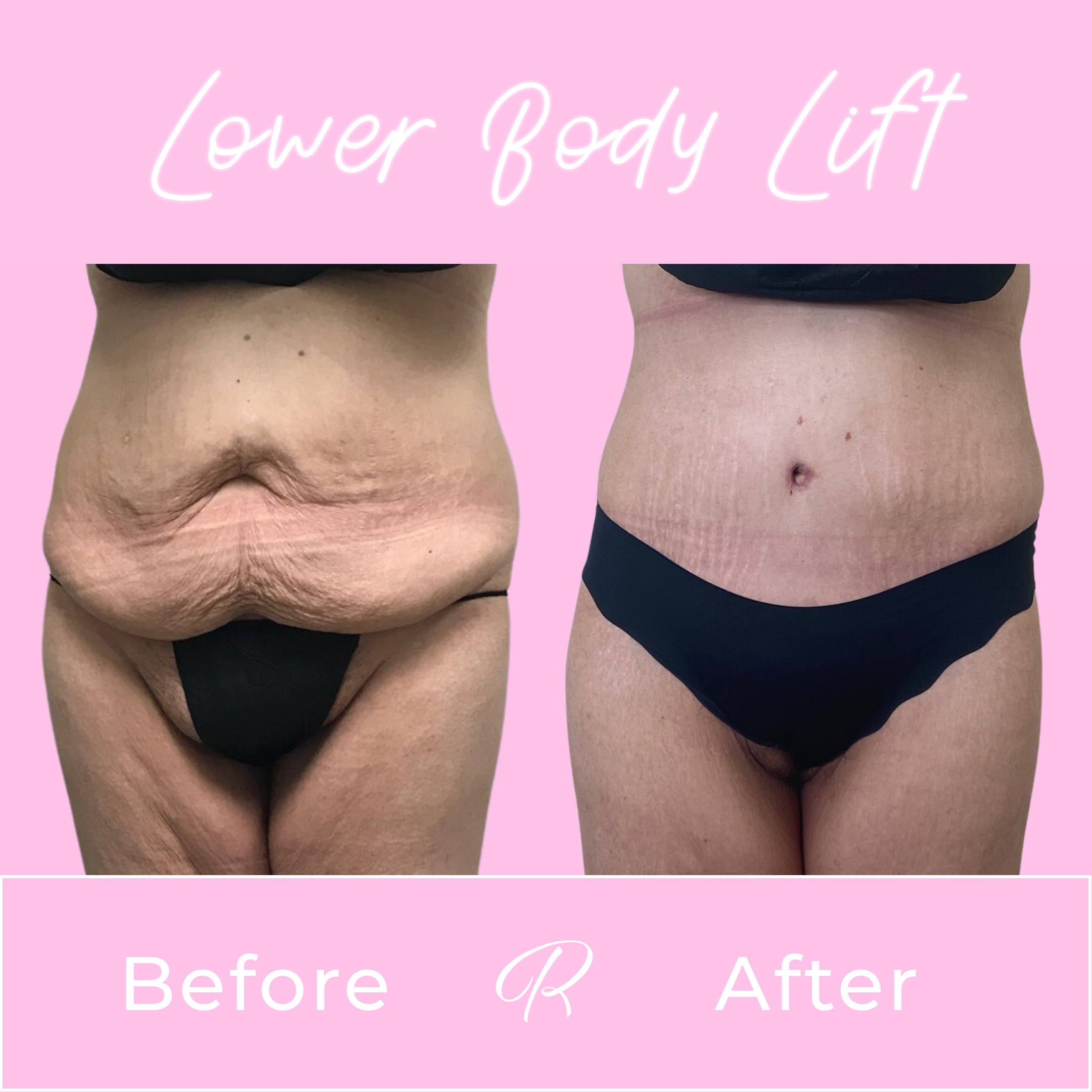 Lower Body Lift Before & After Gallery - Patient 13381 - Image 1