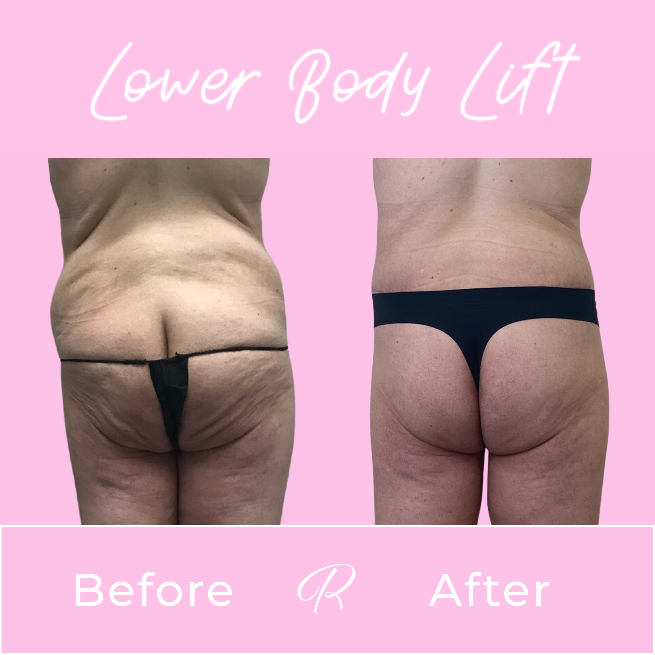 Lower Body Lift Before & After Gallery - Patient 13381 - Image 3