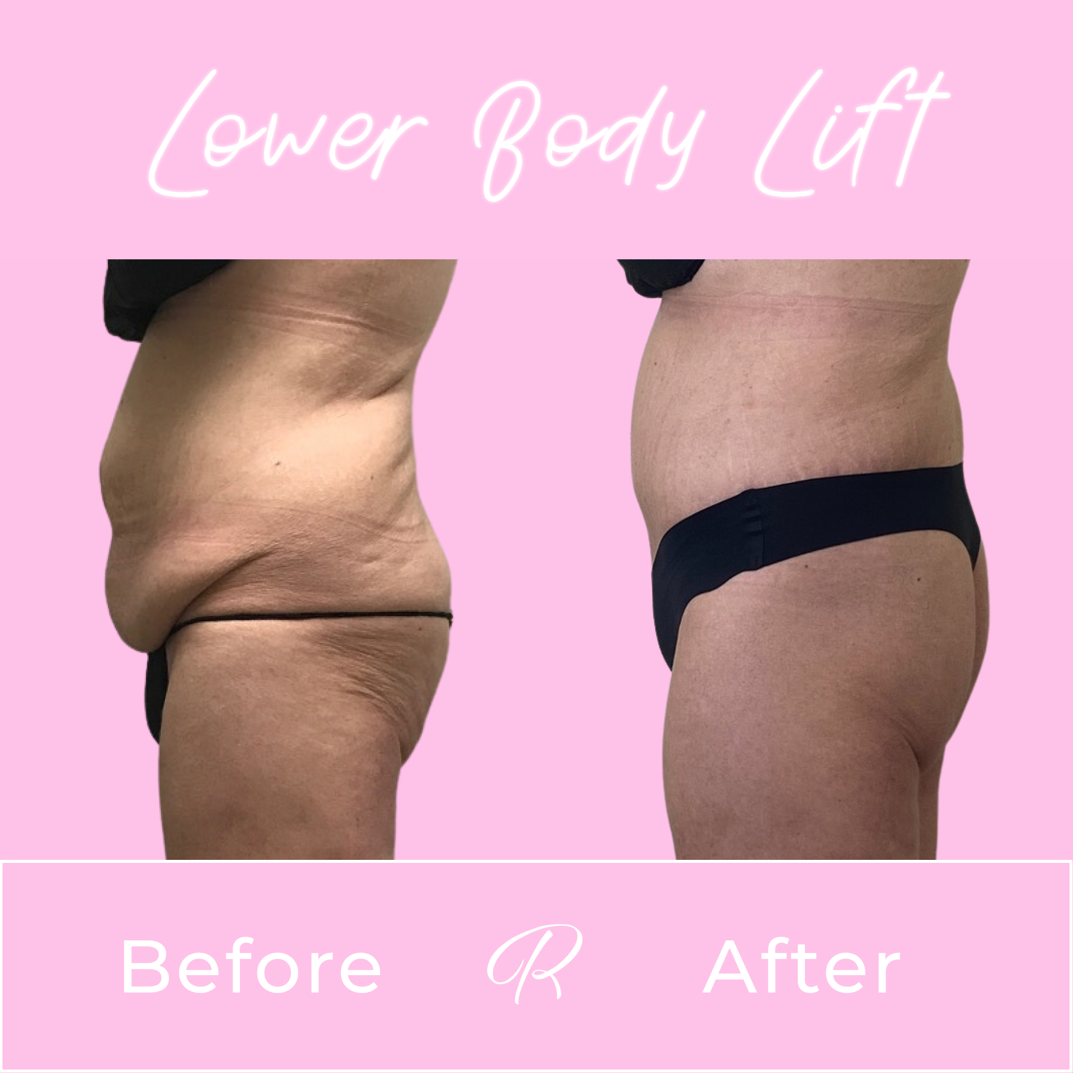 Lower Body Lift Before & After Gallery - Patient 13381 - Image 2