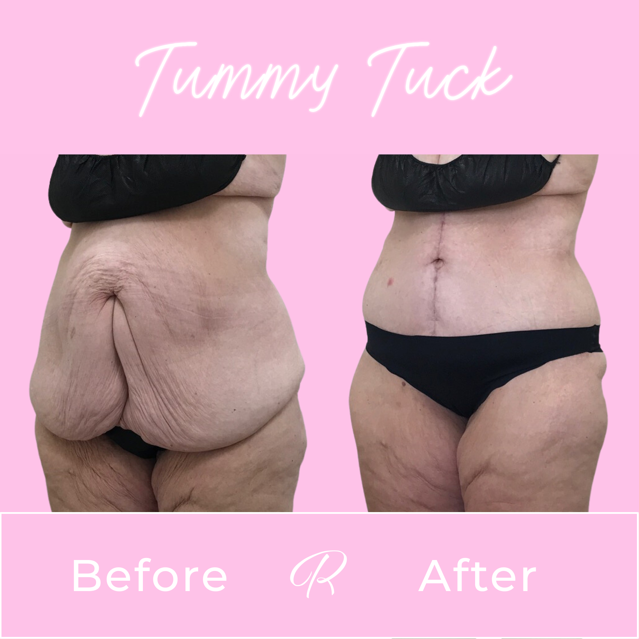 Tummy Tuck Before & After Gallery - Patient 13265 - Image 3