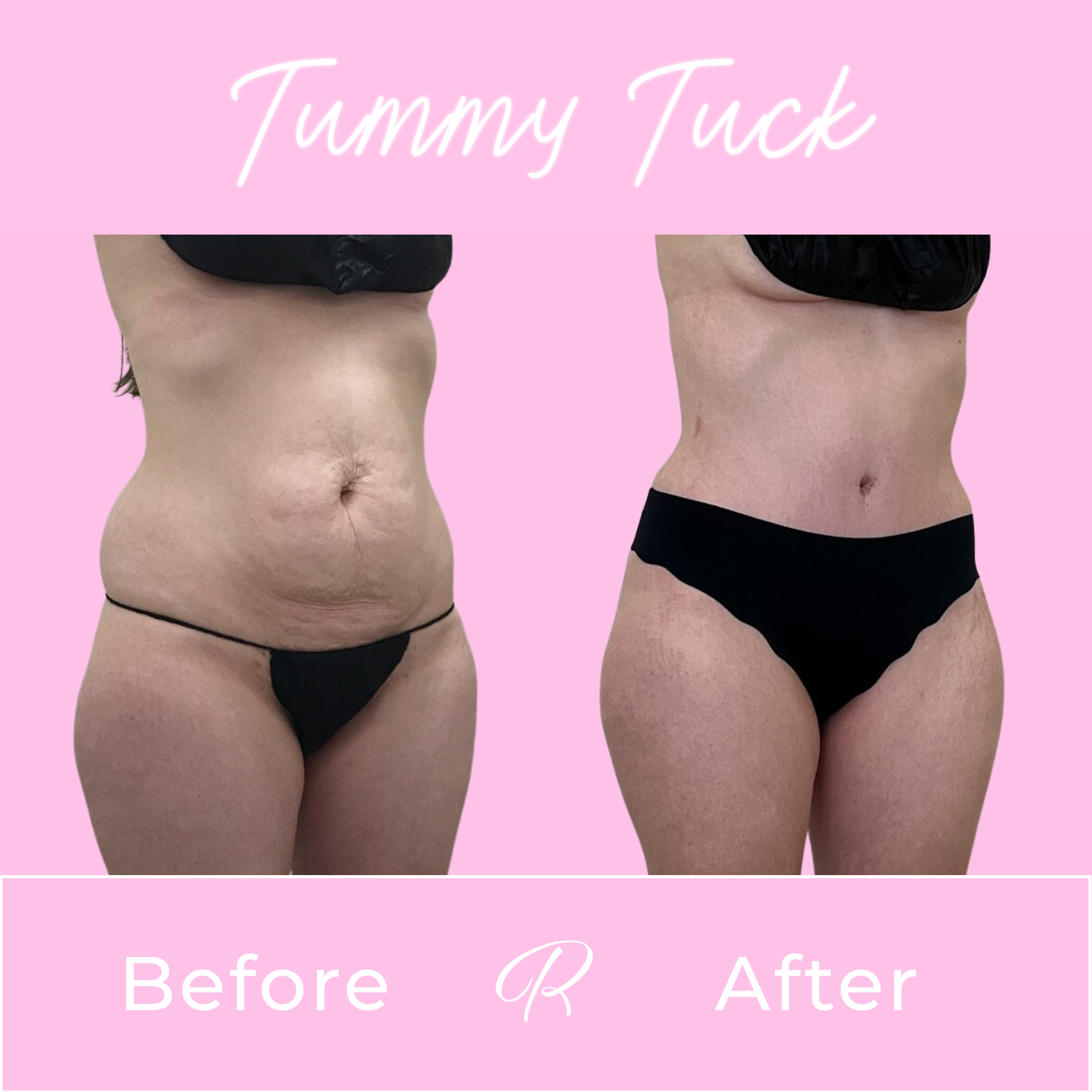 Tummy Tuck Before & After Gallery - Patient 13274 - Image 2