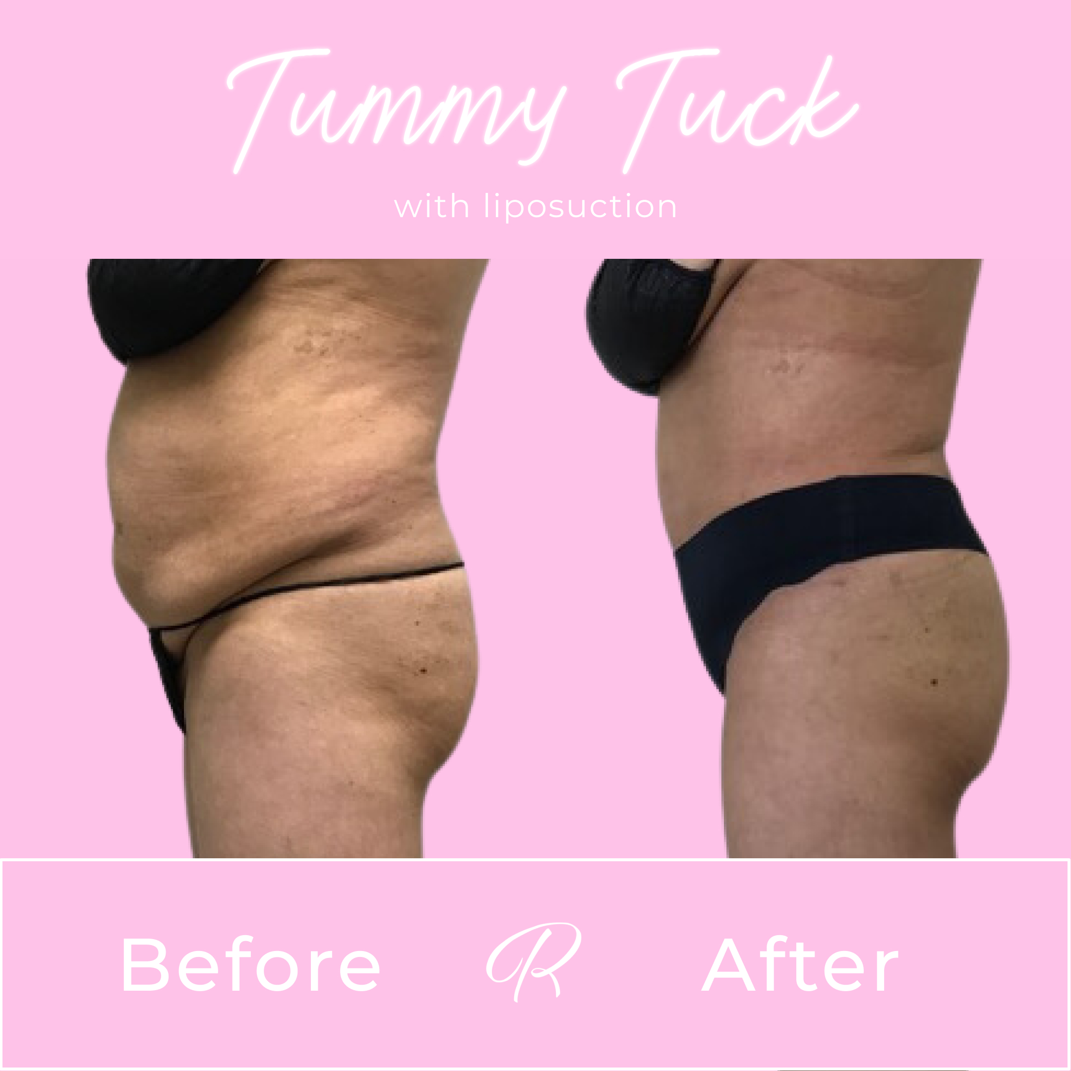 Tummy Tuck Before & After Gallery - Patient 13269 - Image 2