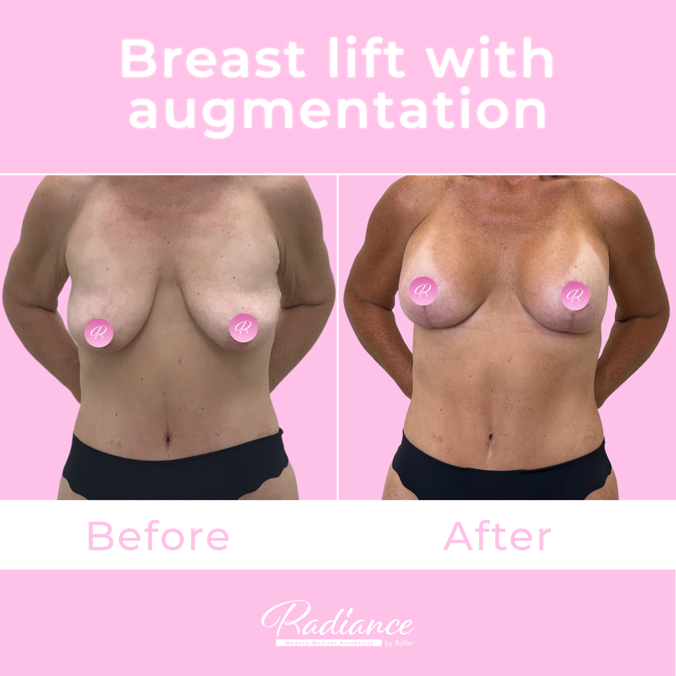 Breast Lift With Augmentation Before & After Gallery - Patient 13425 - Image 1