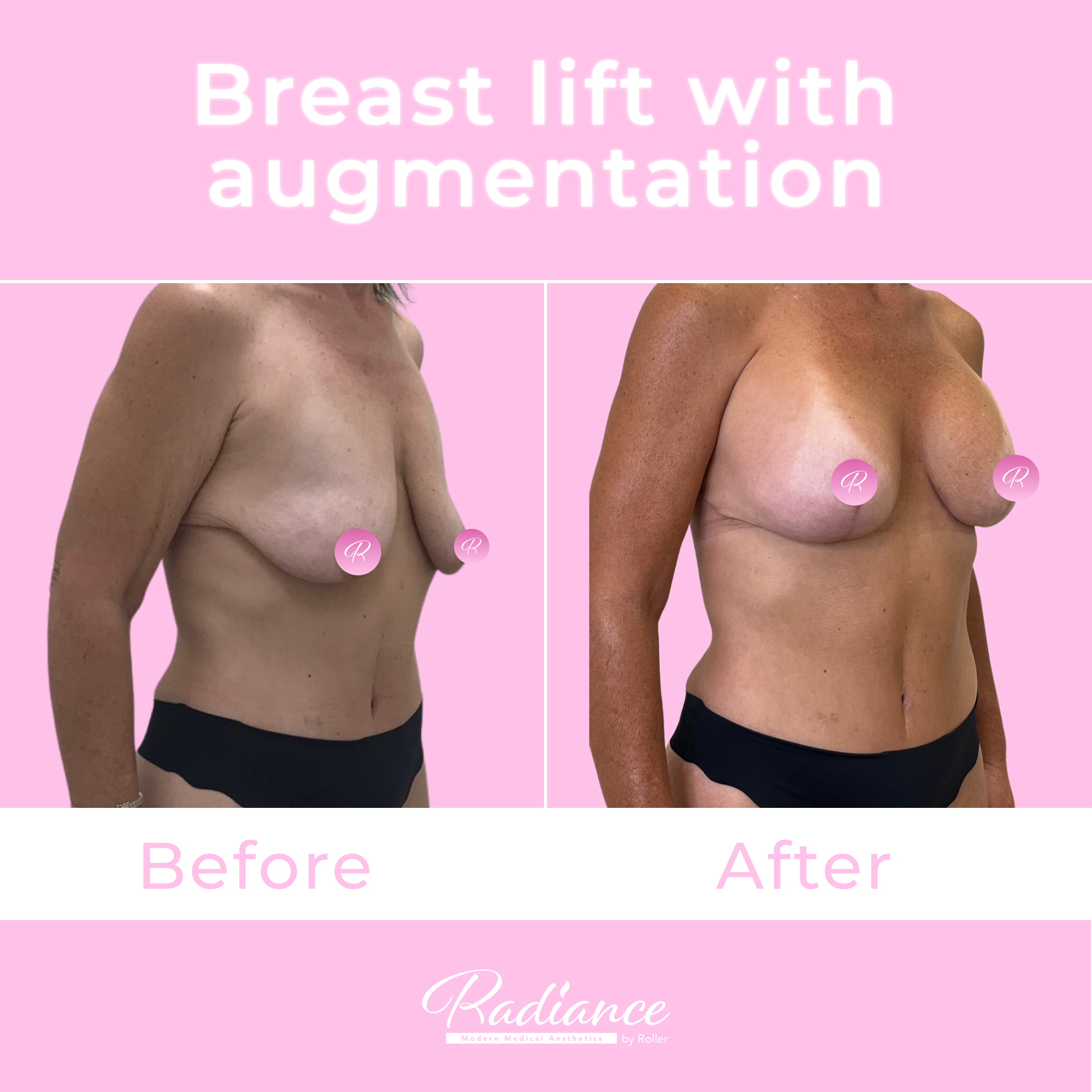 Breast Lift With Augmentation Before & After Gallery - Patient 13425 - Image 4