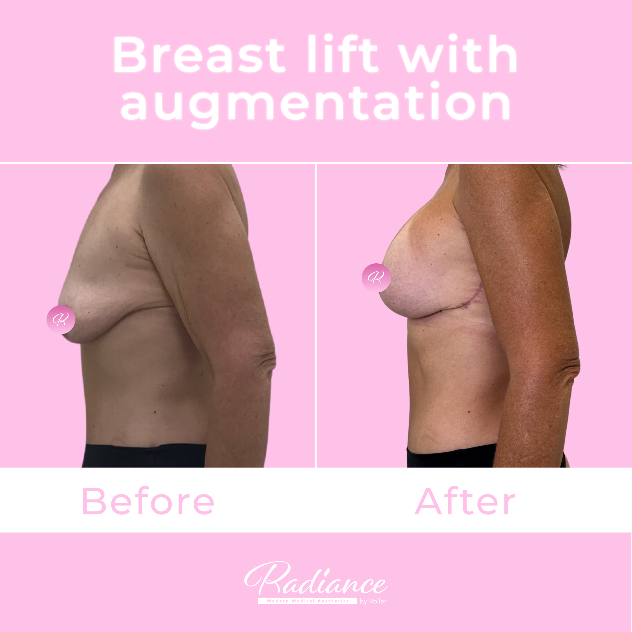 Breast Lift With Augmentation Before & After Gallery - Patient 13425 - Image 3