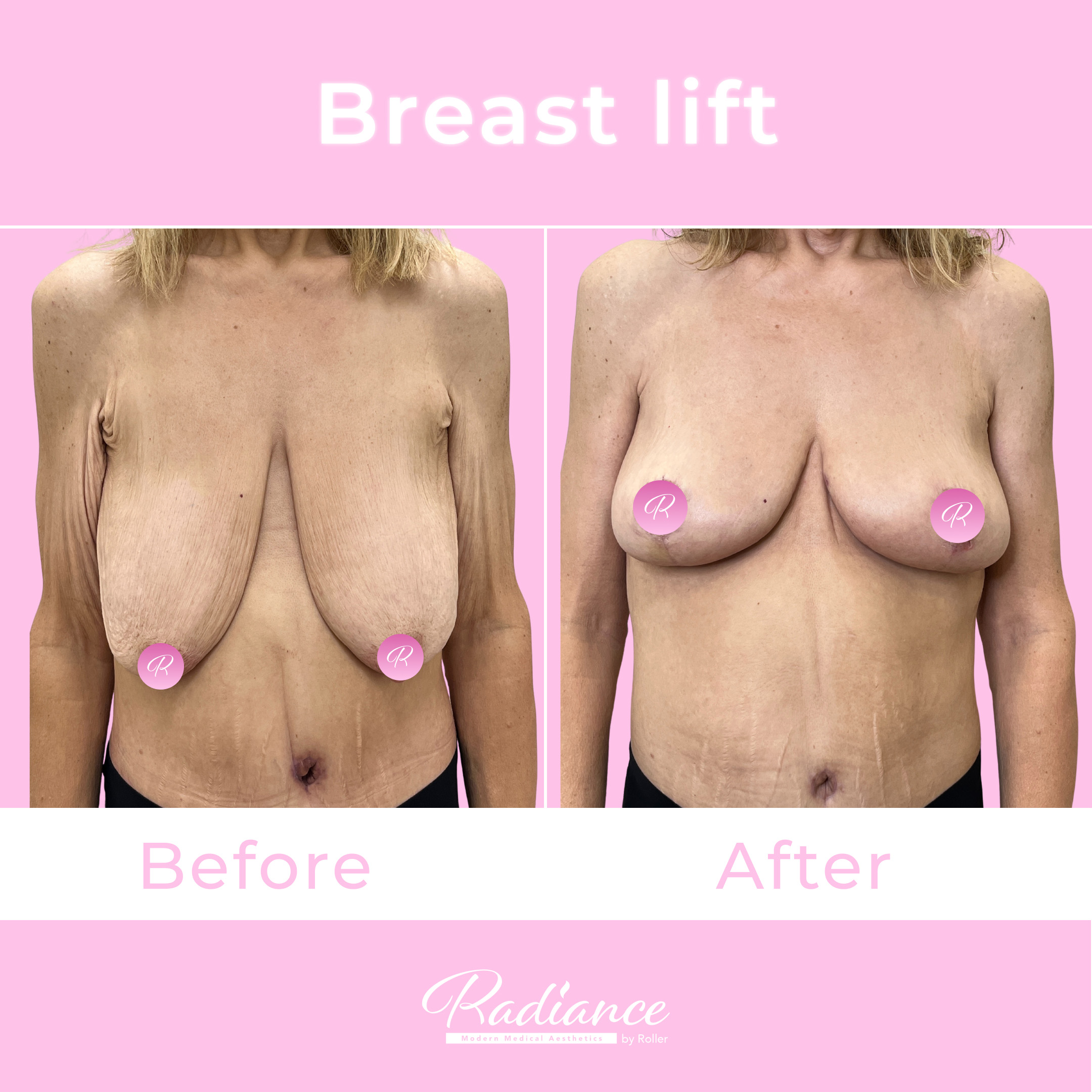 Breast Lift Before & After Gallery - Patient 13416 - Image 1