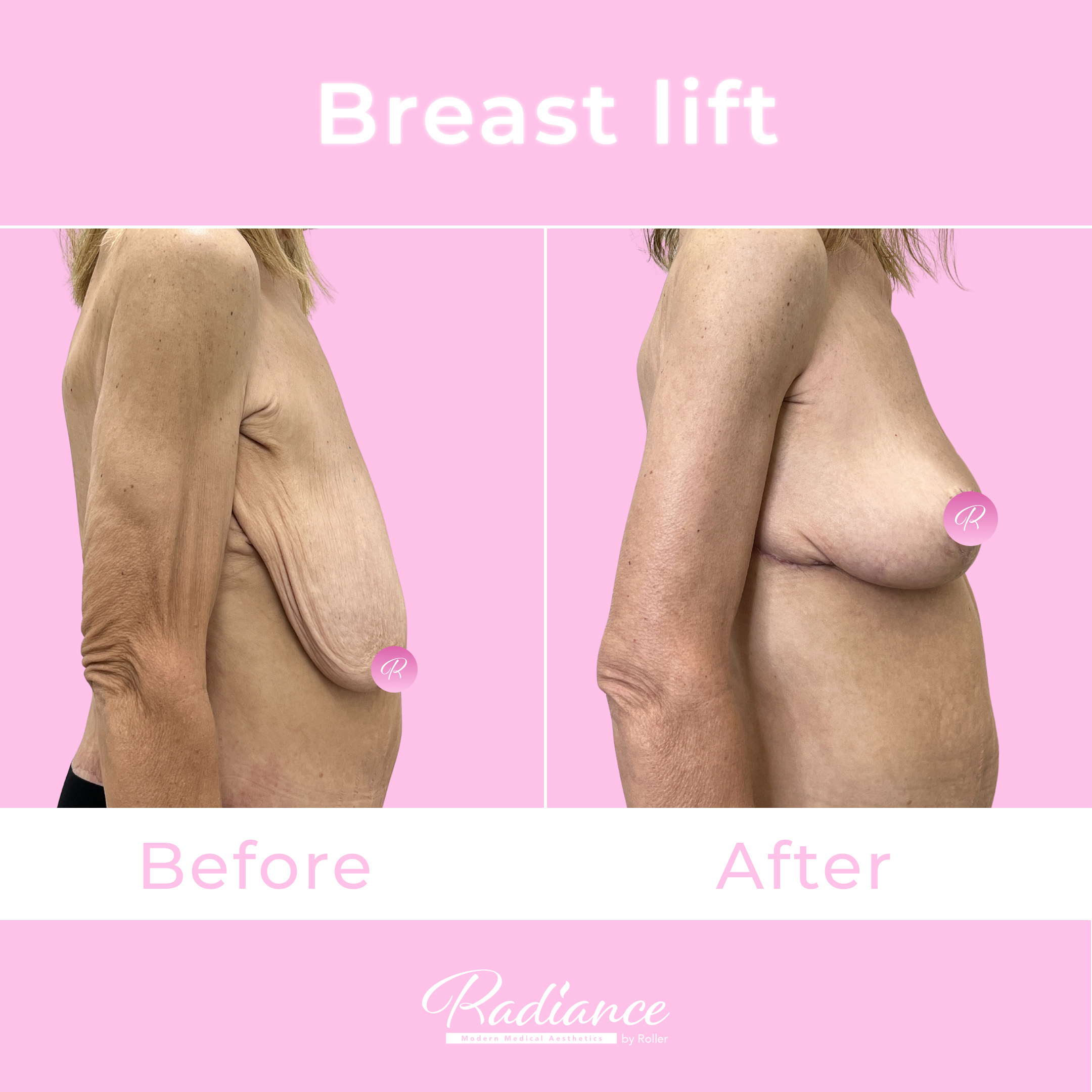 Breast Lift Before & After Gallery - Patient 13416 - Image 3
