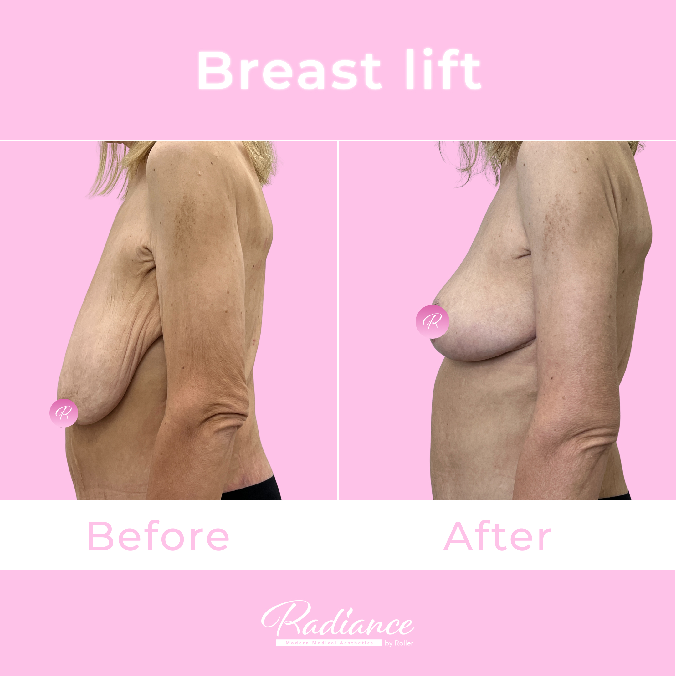Breast Lift Before & After Gallery - Patient 13416 - Image 2