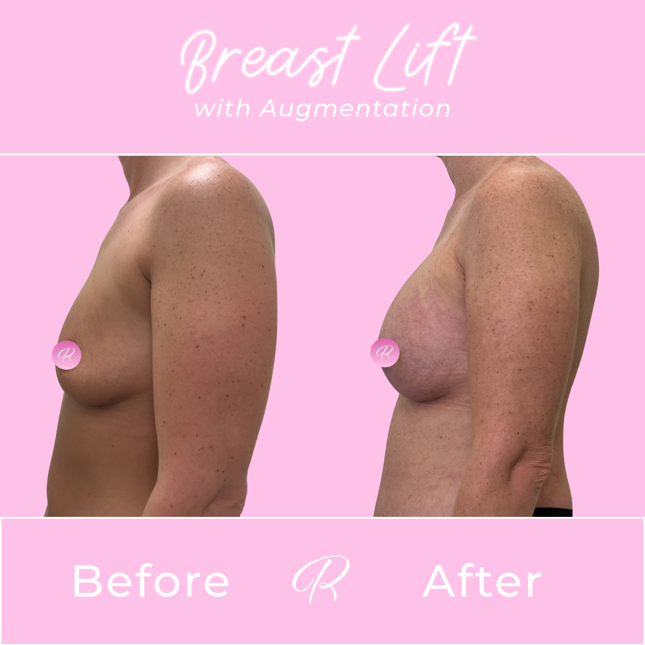 Breast Lift With Augmentation Before & After Gallery - Patient 13426 - Image 2