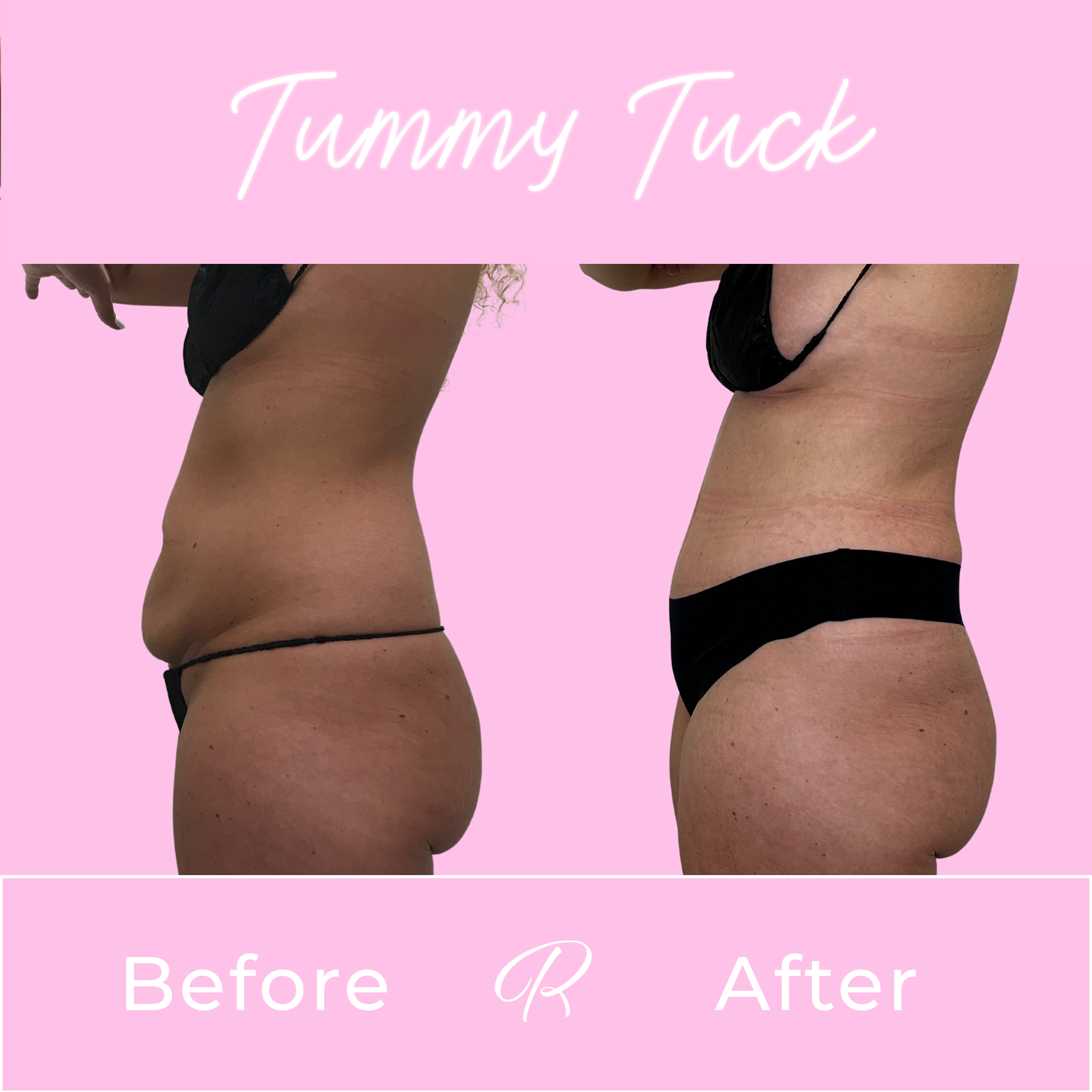 Tummy Tuck Before & After Gallery - Patient 13314 - Image 2