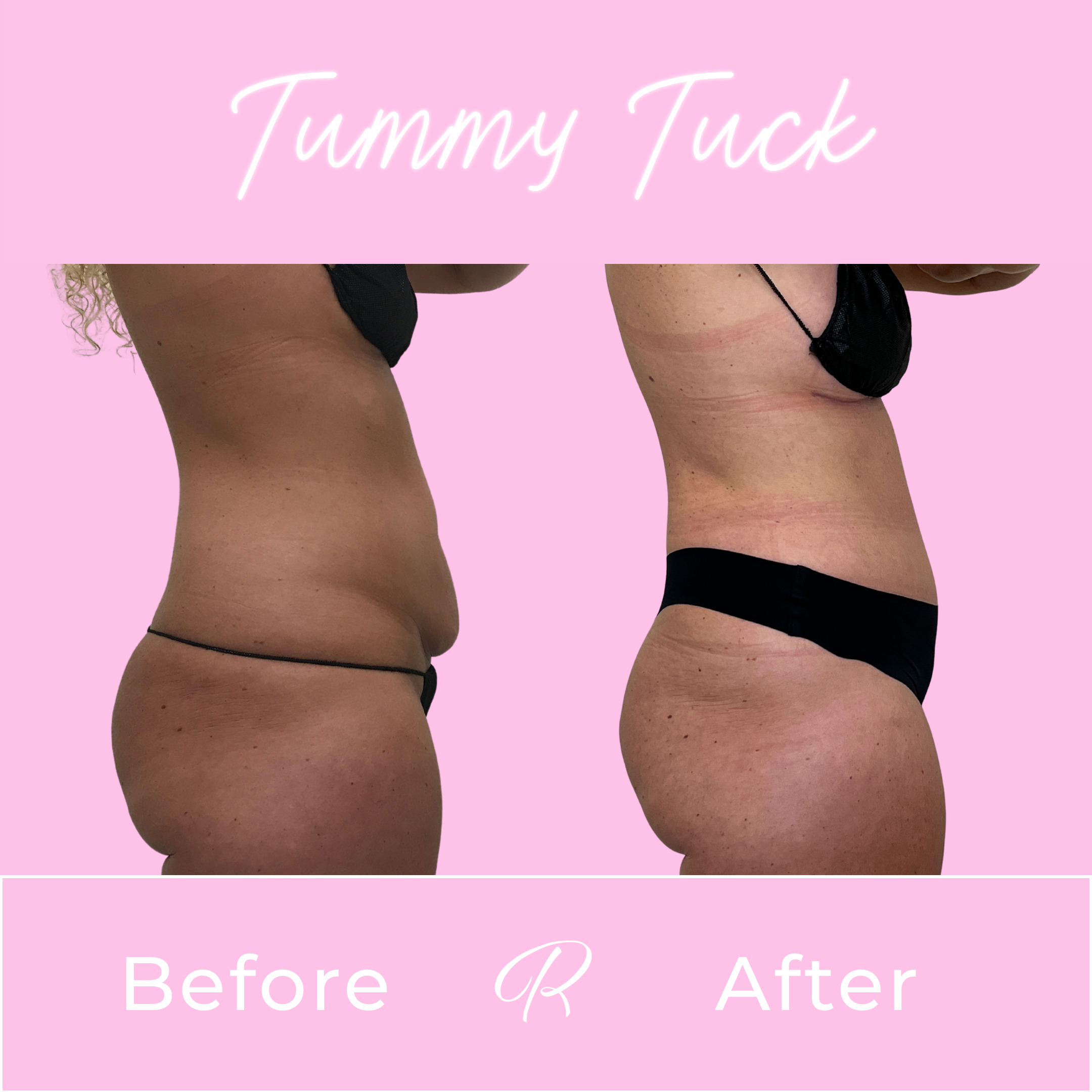 Tummy Tuck Before & After Gallery - Patient 13314 - Image 3