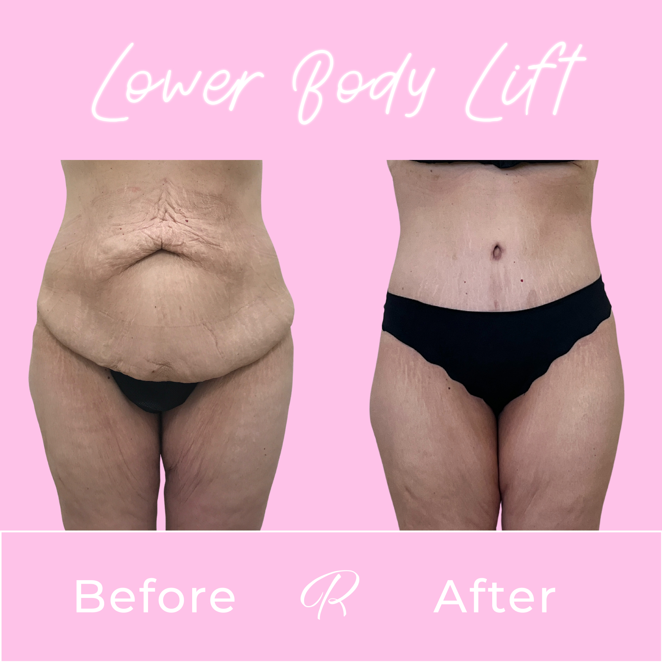 Lower Body Lift Before & After Gallery - Patient 13384 - Image 1