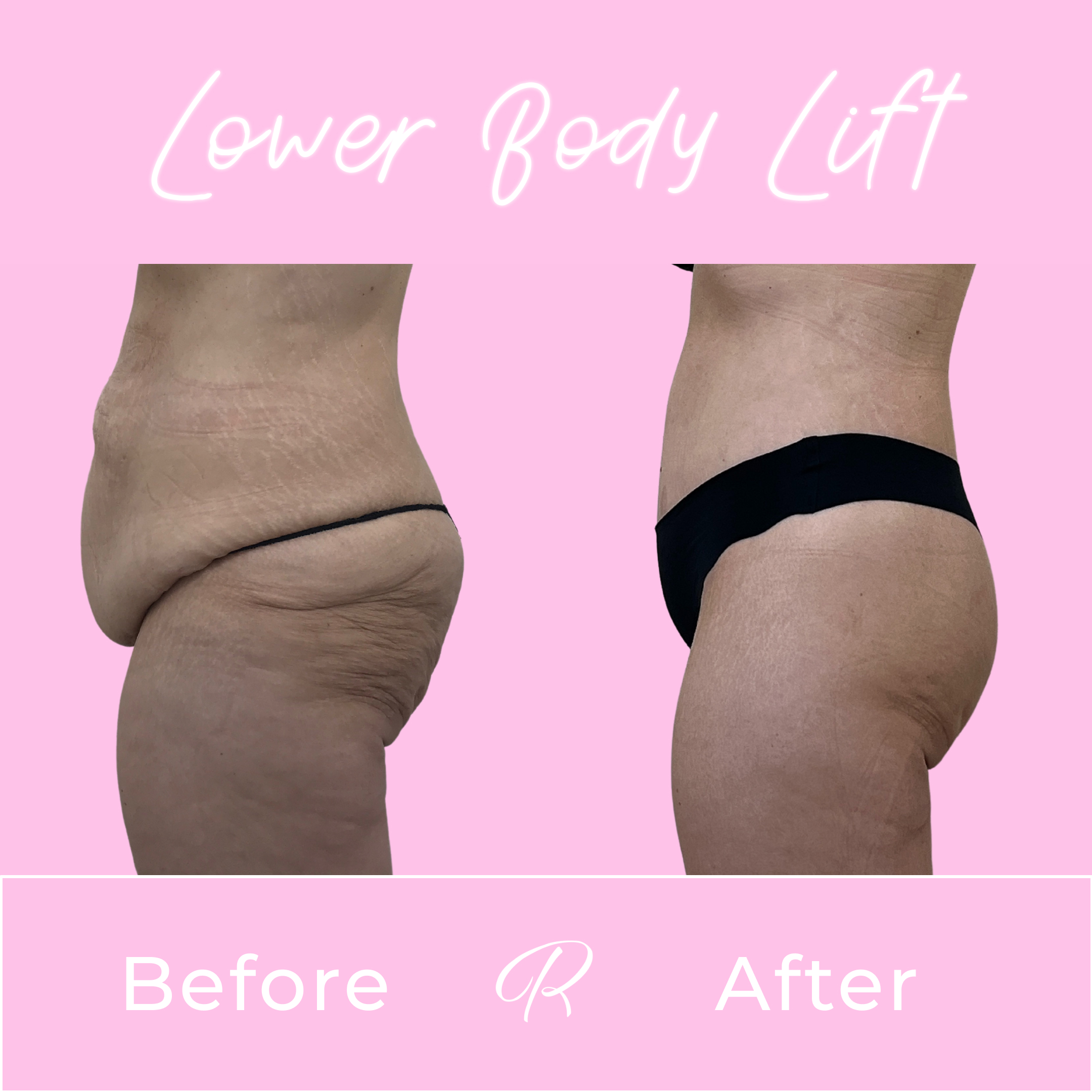 Lower Body Lift Before & After Gallery - Patient 13384 - Image 3