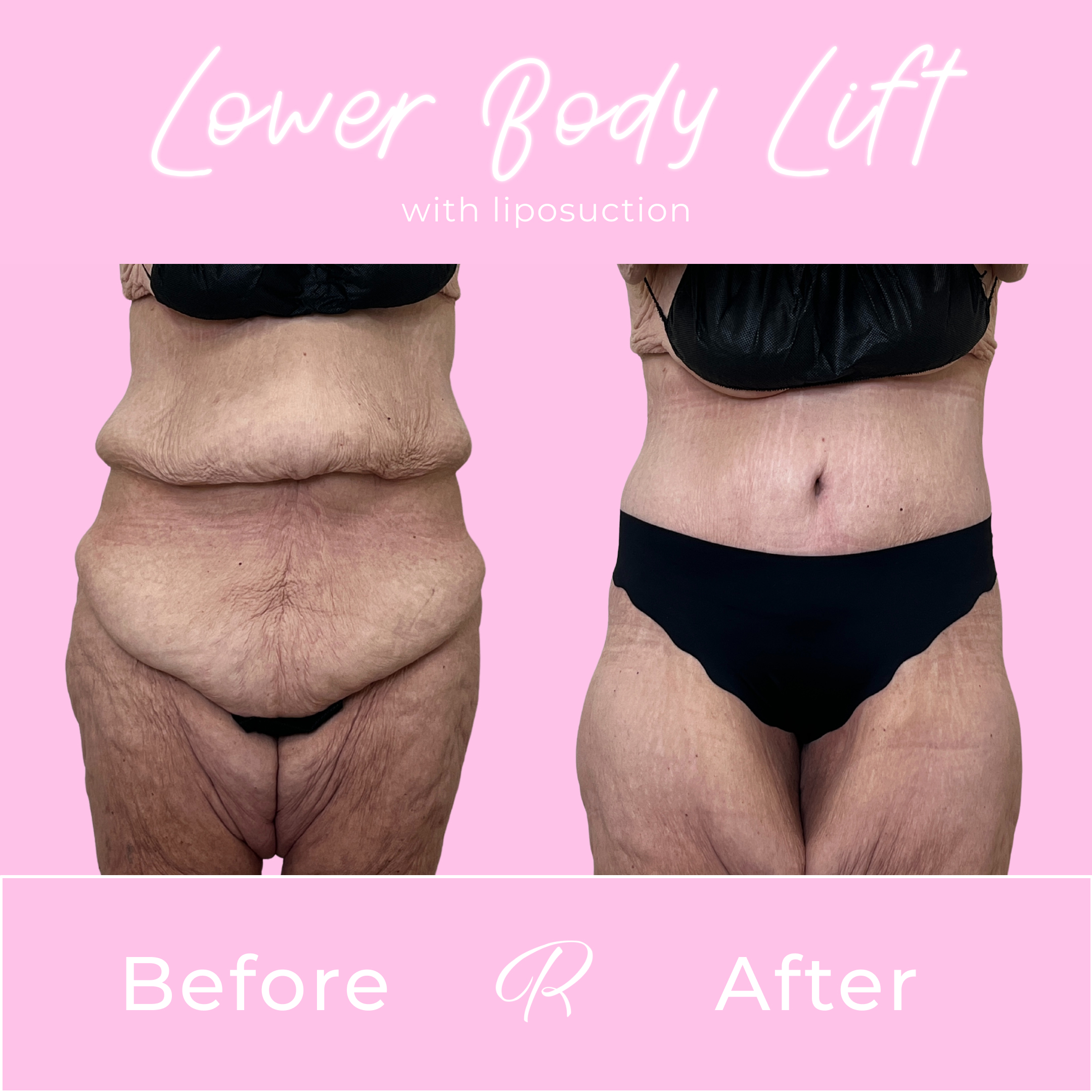 Lower Body Lift Before & After Gallery - Patient 13389 - Image 1