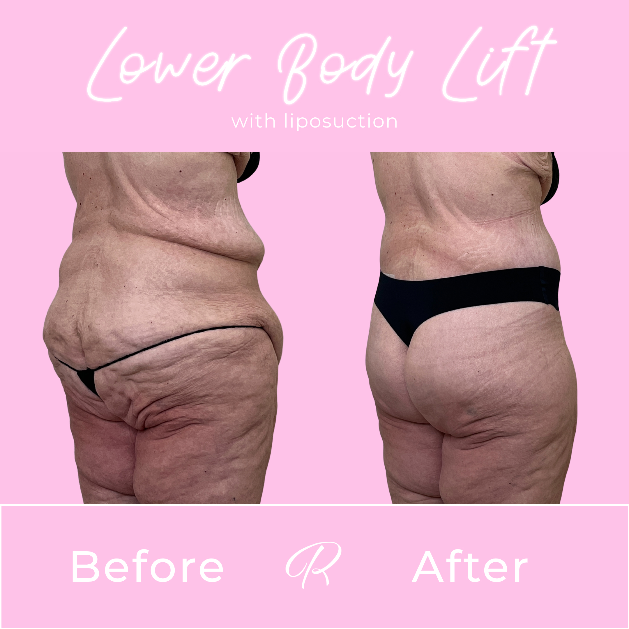 Lower Body Lift Before & After Gallery - Patient 13389 - Image 3
