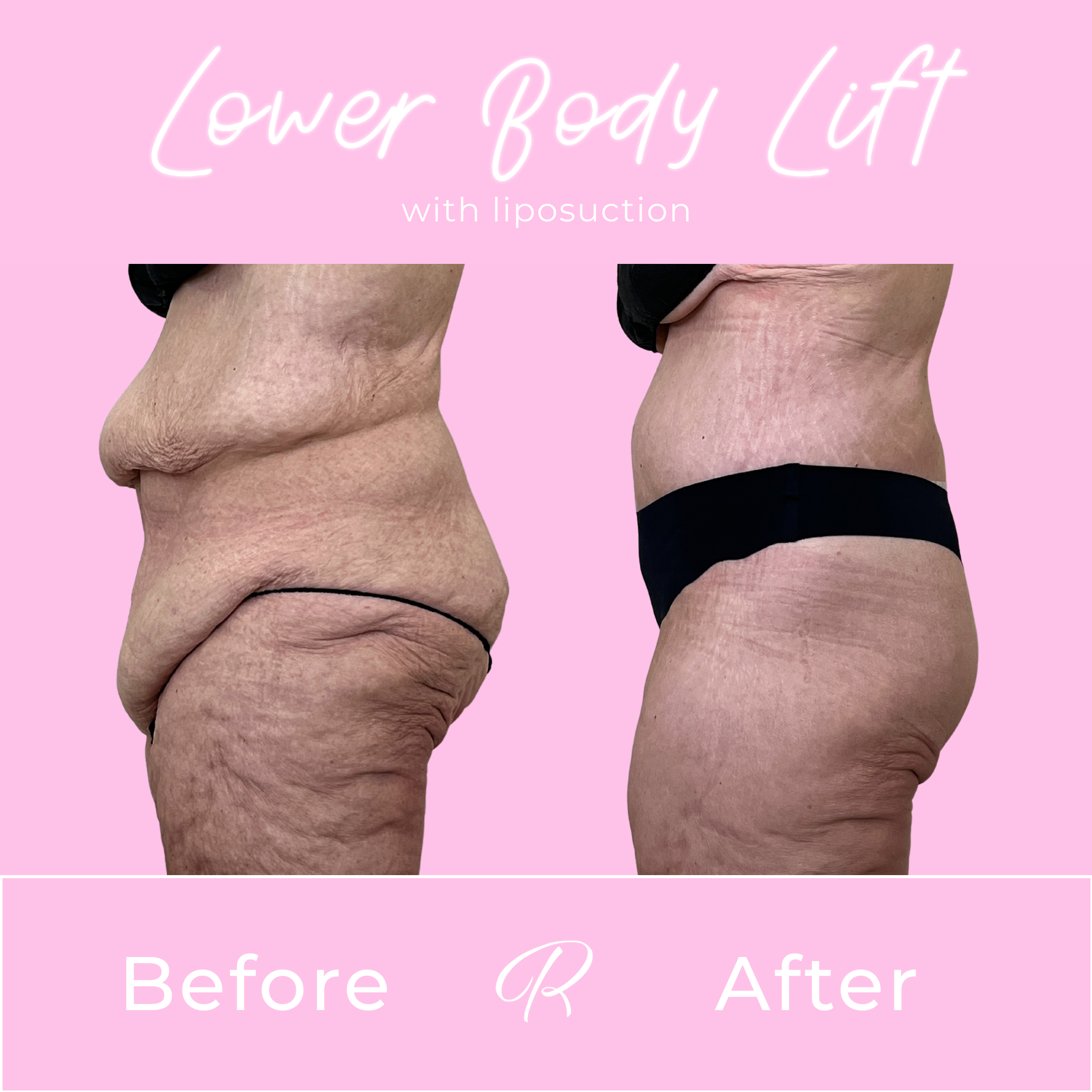 Lower Body Lift Before & After Gallery - Patient 13389 - Image 4