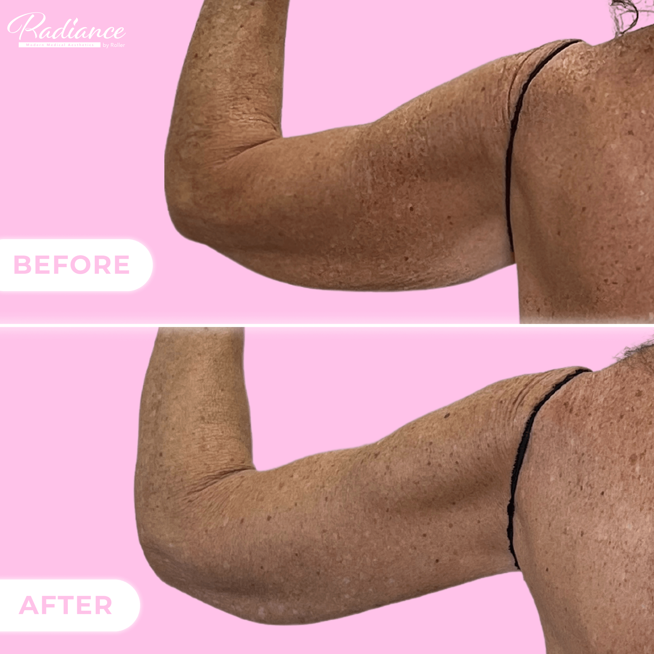 Arm Lift Before & After Gallery - Patient 13439 - Image 2