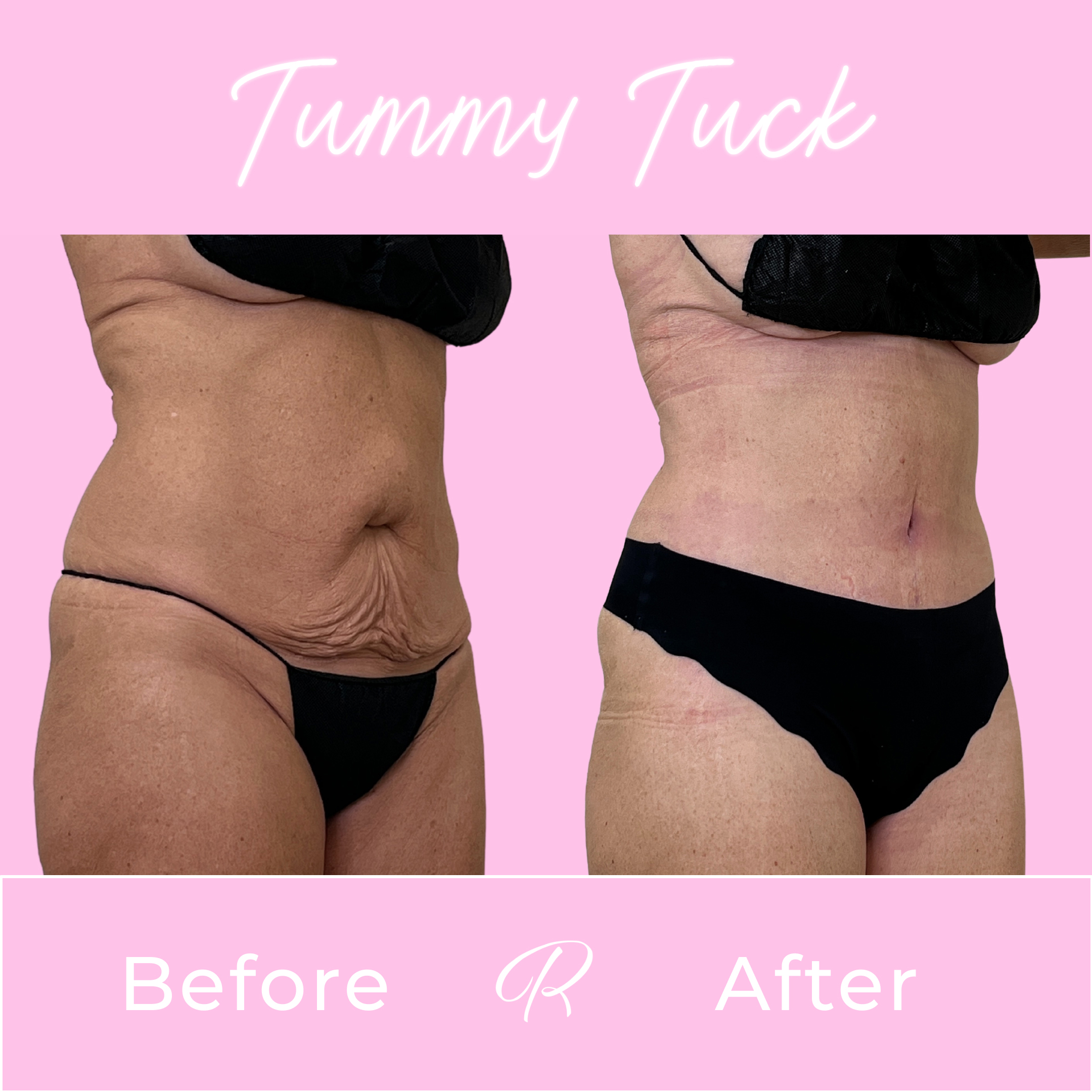 Tummy Tuck Before & After Gallery - Patient 13318 - Image 2