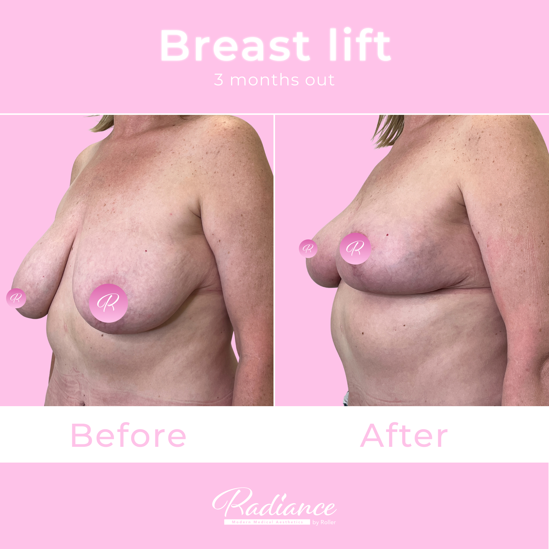 Breast Lift Before & After Gallery - Patient 13410 - Image 2