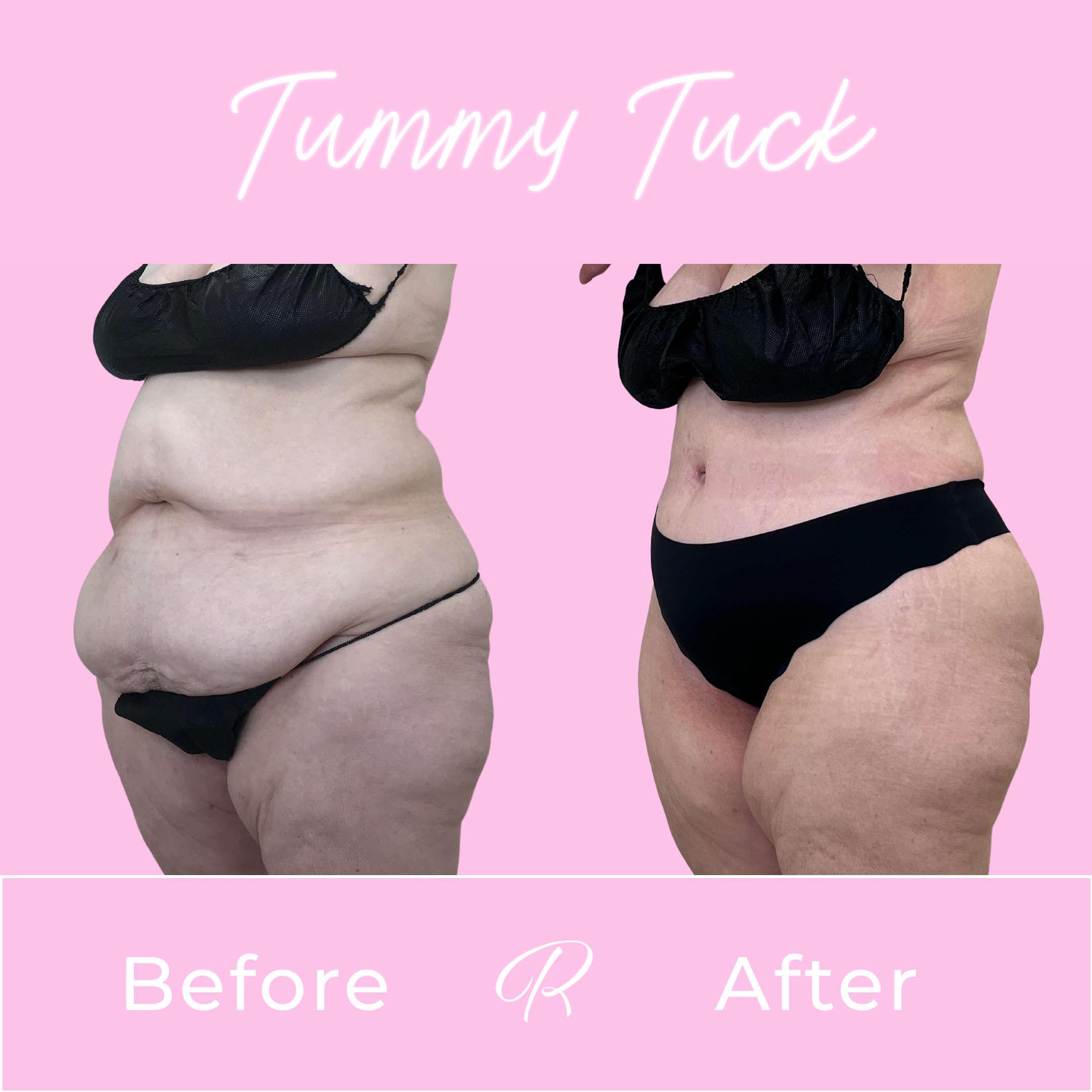 Tummy Tuck Before & After Gallery - Patient 13326 - Image 2