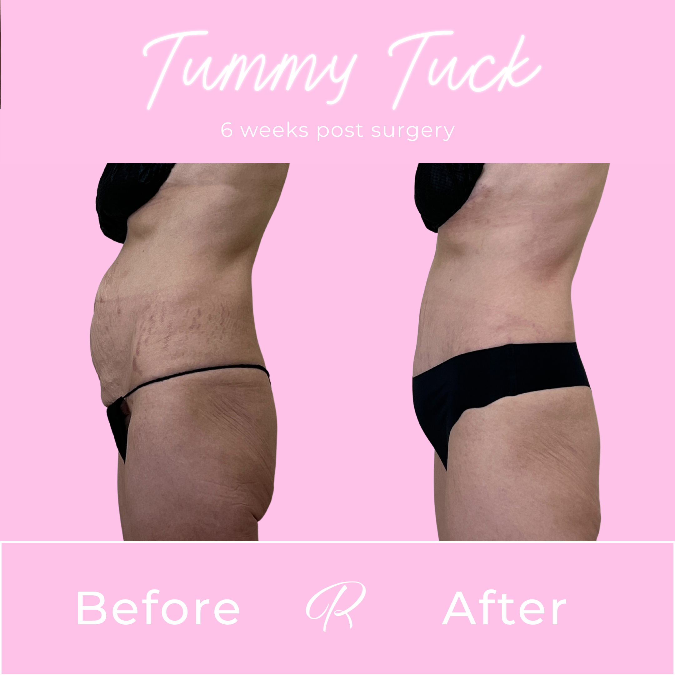 Tummy Tuck Before & After Gallery - Patient 13334 - Image 3
