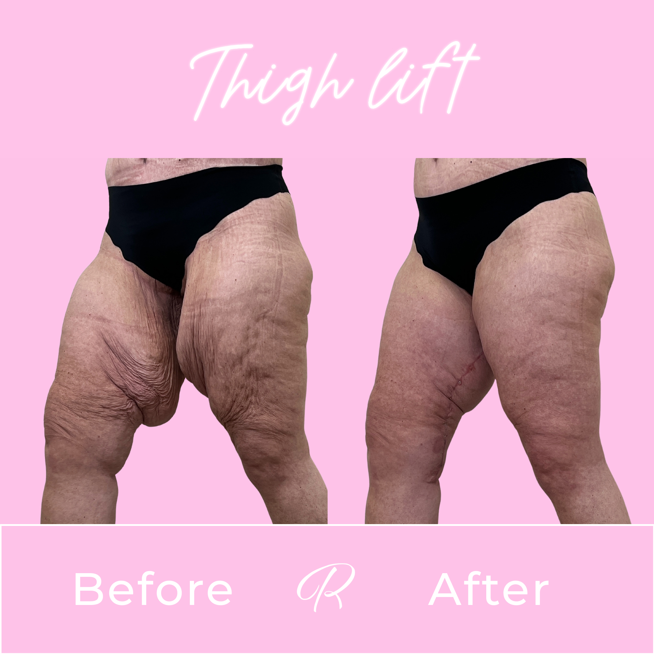 Thigh Lift Before & After Gallery - Patient 13372 - Image 3