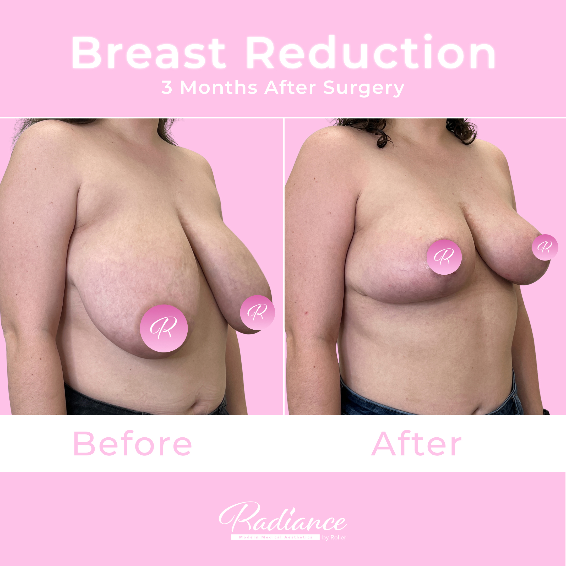 Breast Reduction Before & After Gallery - Patient 13396 - Image 3