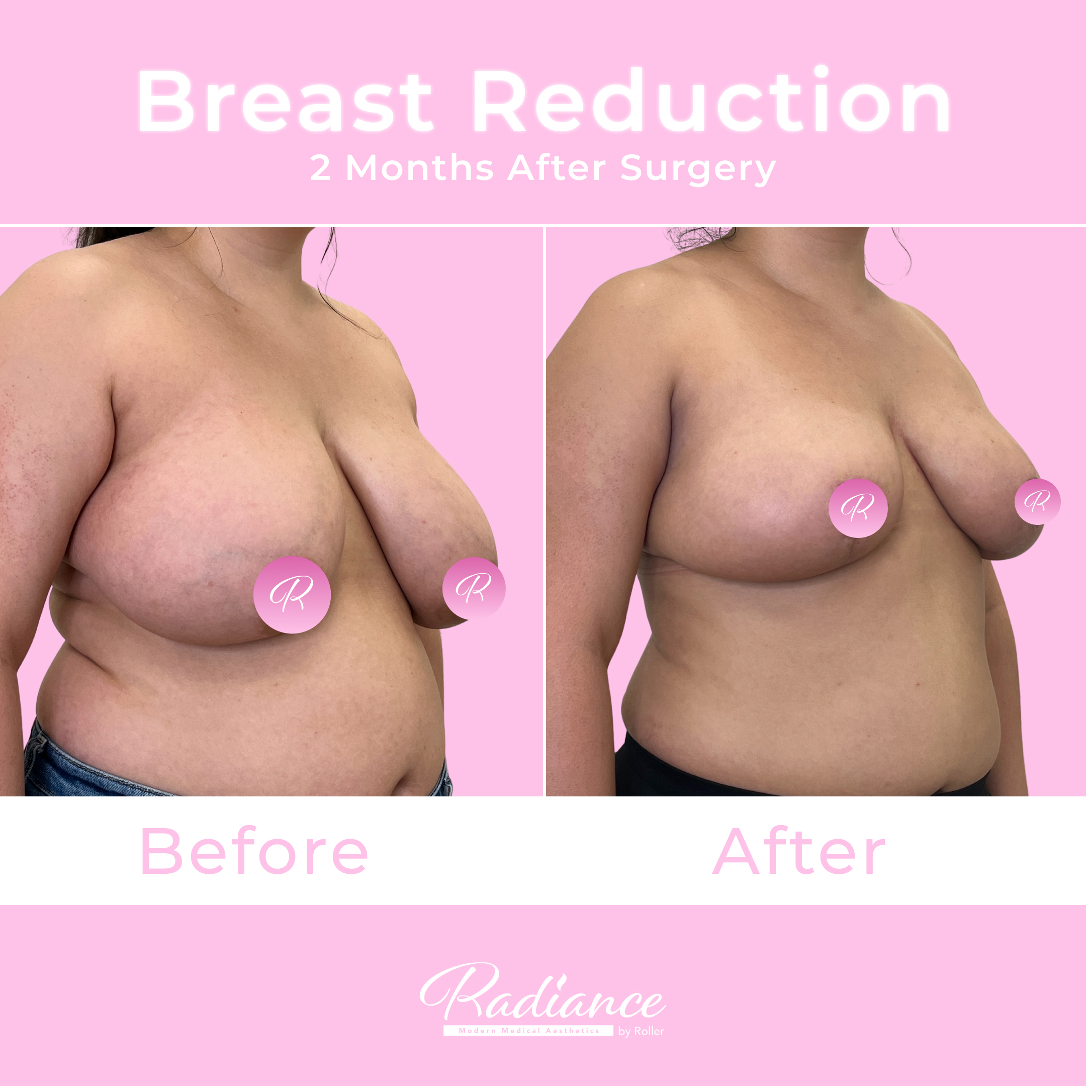 Breast Reduction Before & After Gallery - Patient 13402 - Image 2