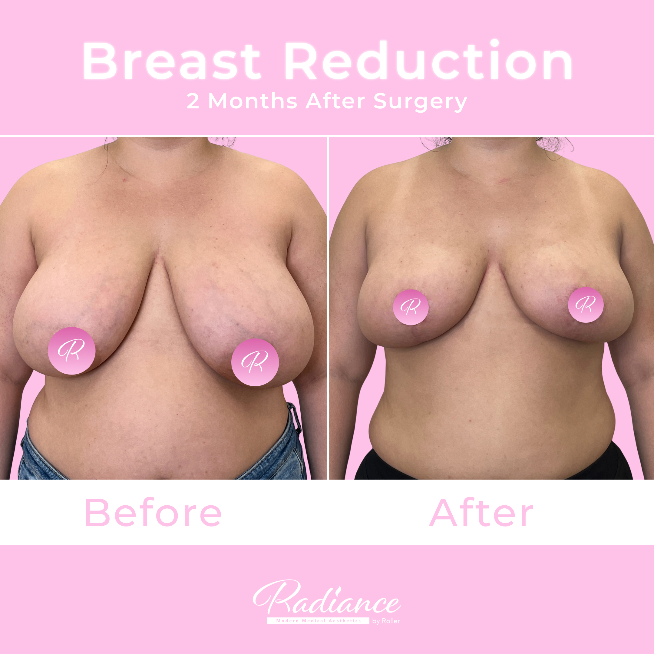 Breast Reduction Before & After Gallery - Patient 13402 - Image 1