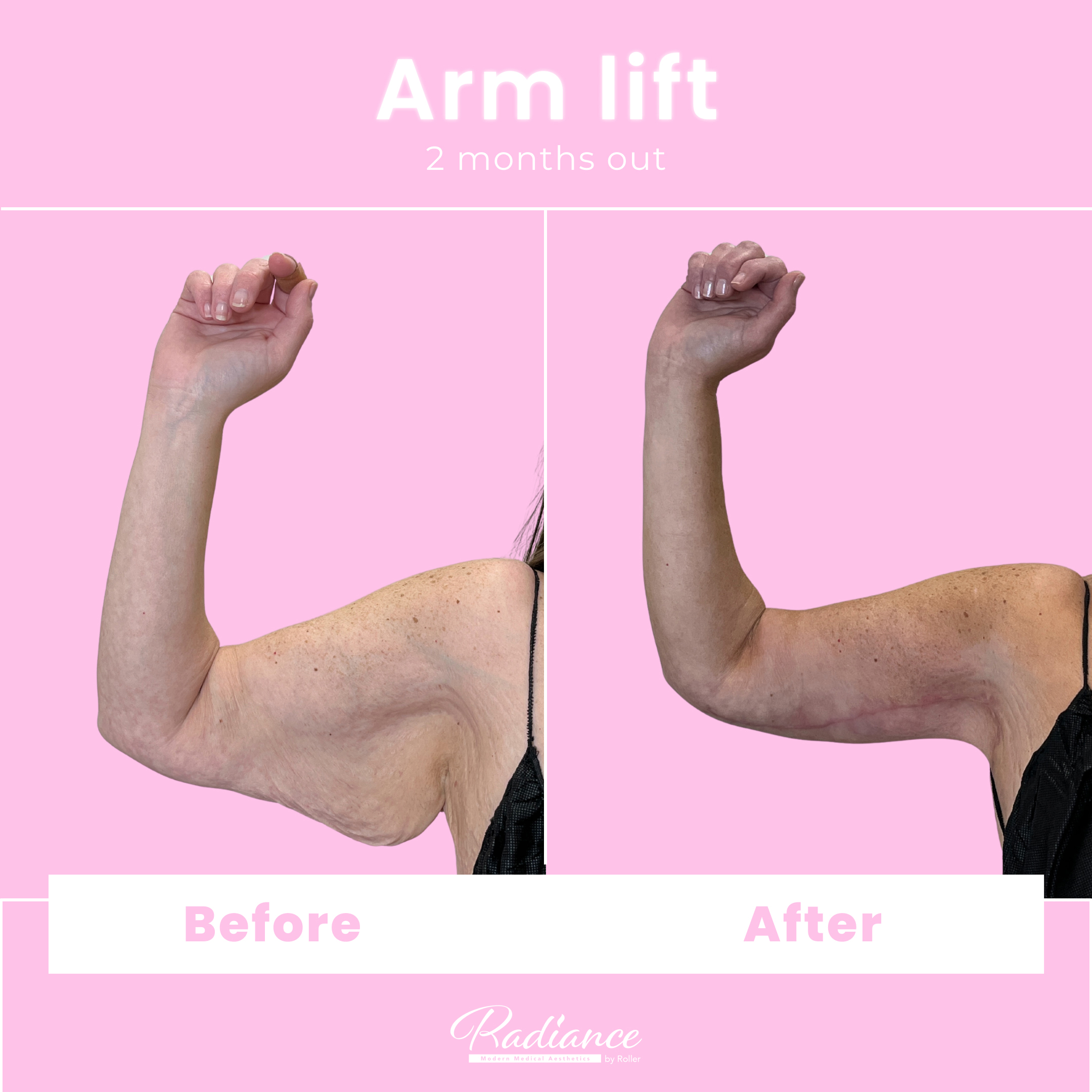 Arm Lift Before & After Gallery - Patient 13442 - Image 1