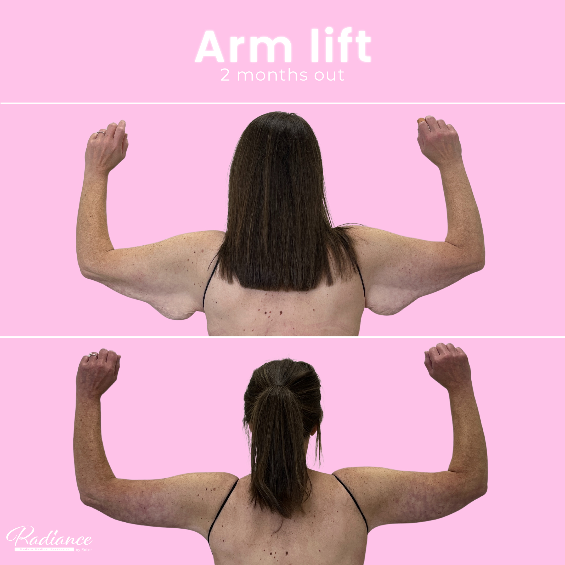 Arm Lift Before & After Gallery - Patient 13442 - Image 2