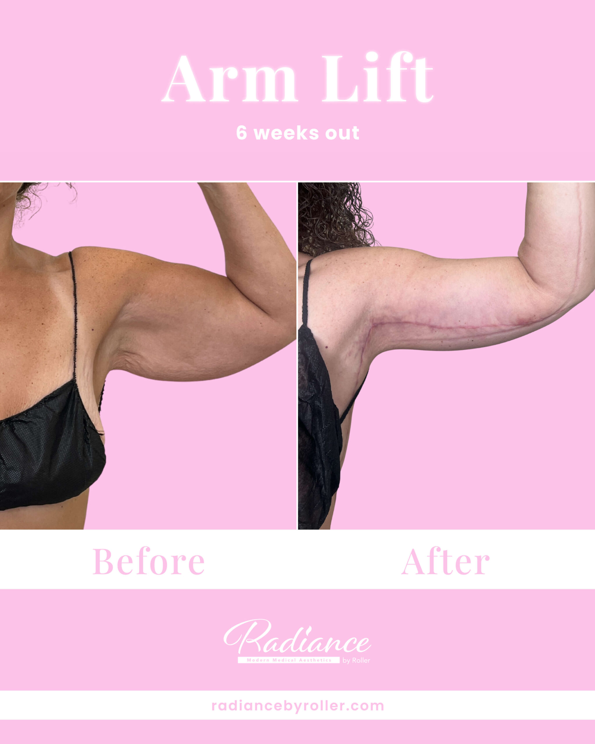 Arm Lift Before & After Gallery - Patient 13445 - Image 3