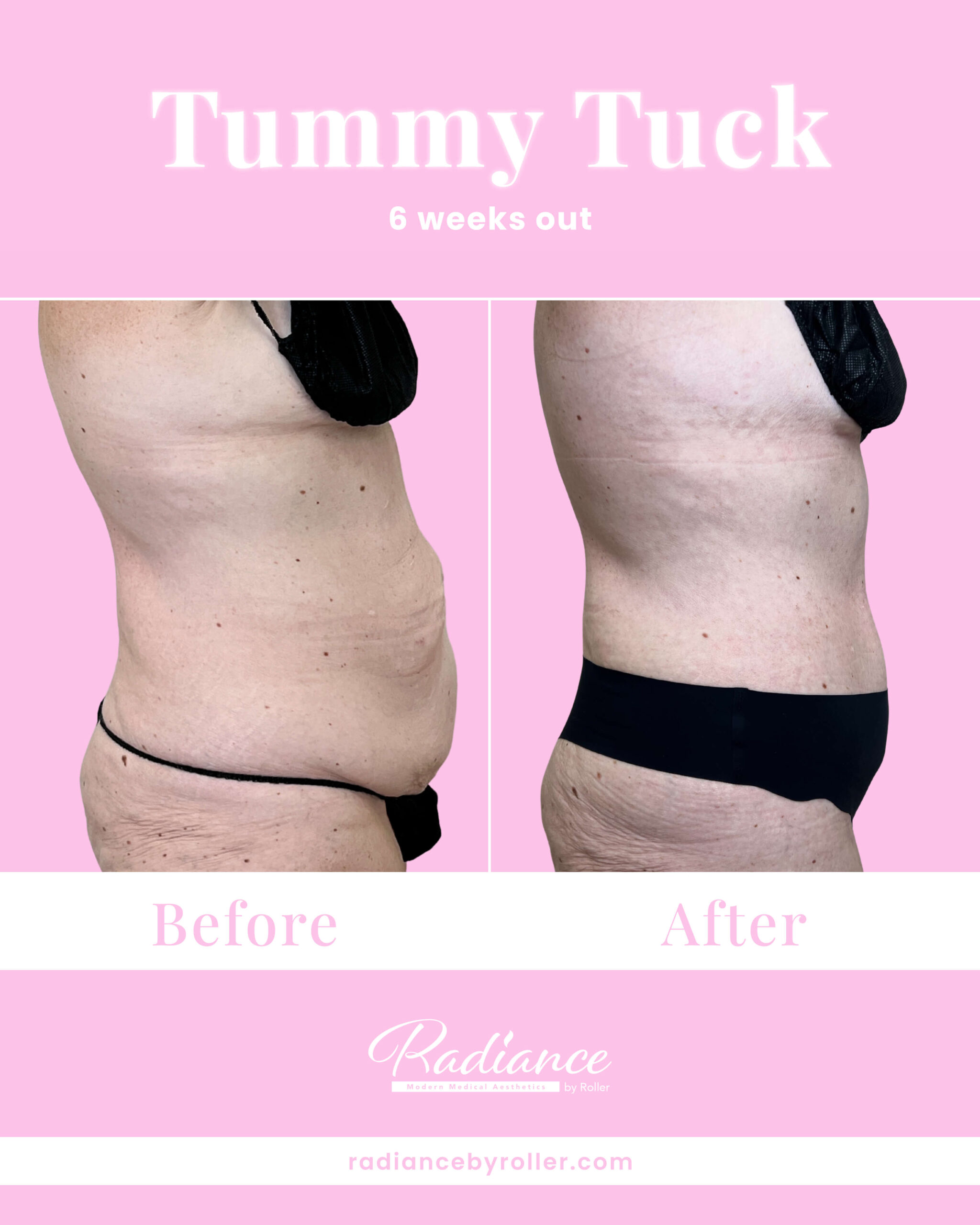 Tummy Tuck Before & After Gallery - Patient 13349 - Image 3