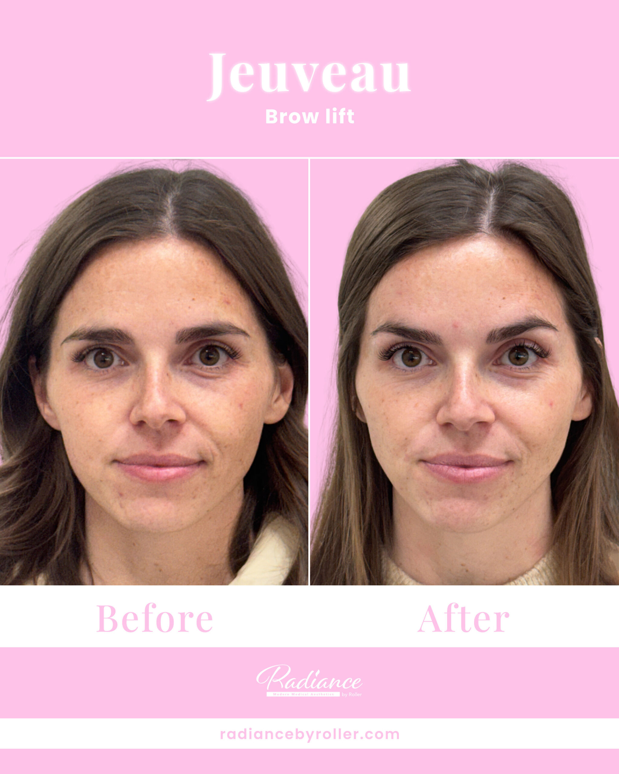 Jeuveau Before & After Gallery - Patient 14716 - Image 1